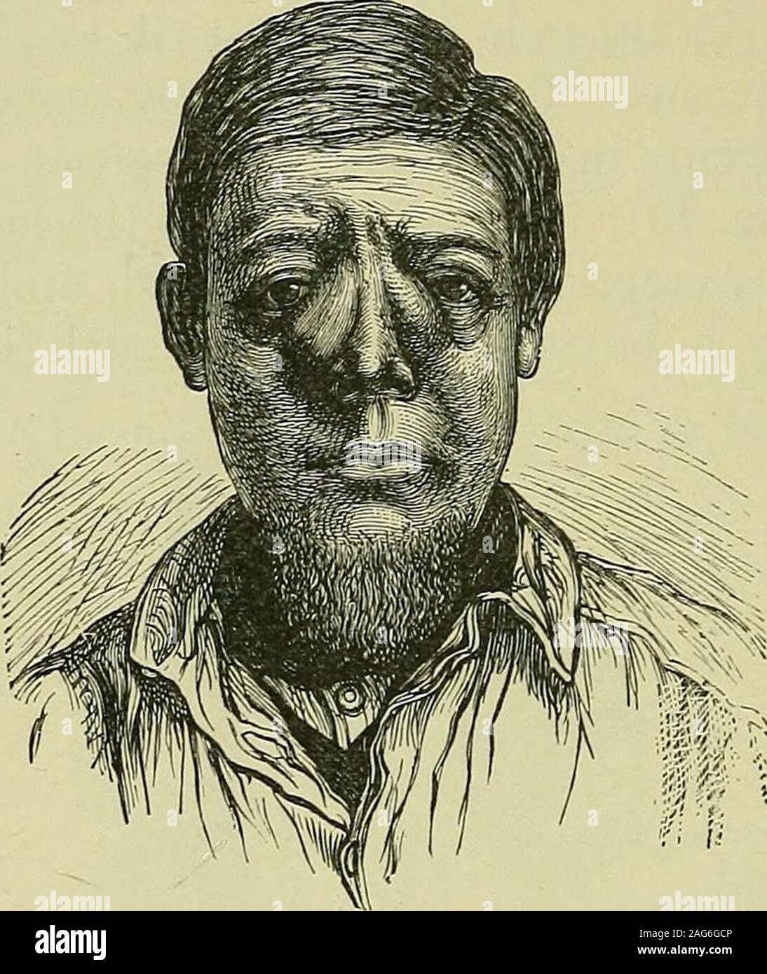 . Tumori, innocente e patologie maligne; i loro caratteri clinici e un trattamento adeguato. Fig. 20.-Exostosis del femore, prodotta da ossificazione del tendine del theadductor magnus. {Museo del Royal College of Surgeons.) e poi arredate con villi, e organi allentati beenfound hanno in loro (Orlov/ e Riethus). Cura deve essere takennot per confondere un su23racondyloid processo dell'omero, oppurele occasionali di terzo trocantere del femore, con exostoses. Outgrowths localizzate sono molto comuni sul facialbones, specialmente i processi nasale del maxillfe, wherethey può essere unilaterale o bilat Foto Stock