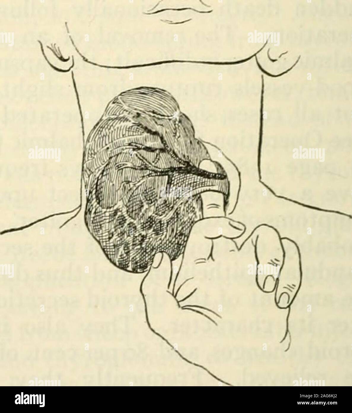 . La moderna chirurgia generale e operativa. Fig. 889.-Kochers incisione trasversale Fig. 890.-isolando l'accessorio veinsexposing i muscoli e vene mediano di (Kocher). il collo (Kocher). La crescita è tessuto ghiandolare. Il funzionamento di enucleazione non è adatto alla theremoval di tumori multipli e non può essere eseguito per parenchymatousgoiter o exophthalmic gozzo. Di enucleazione Intraglandular è eseguita nelseguente modo: la tiroide è esposto da una barra obliqua o da una incisione trasversale. Anincision è realizzato attraverso la capsula della ghiandola tiroide e attraverso il premistoppa-tessuto ular finché la cisti o rapporto di integrità Foto Stock