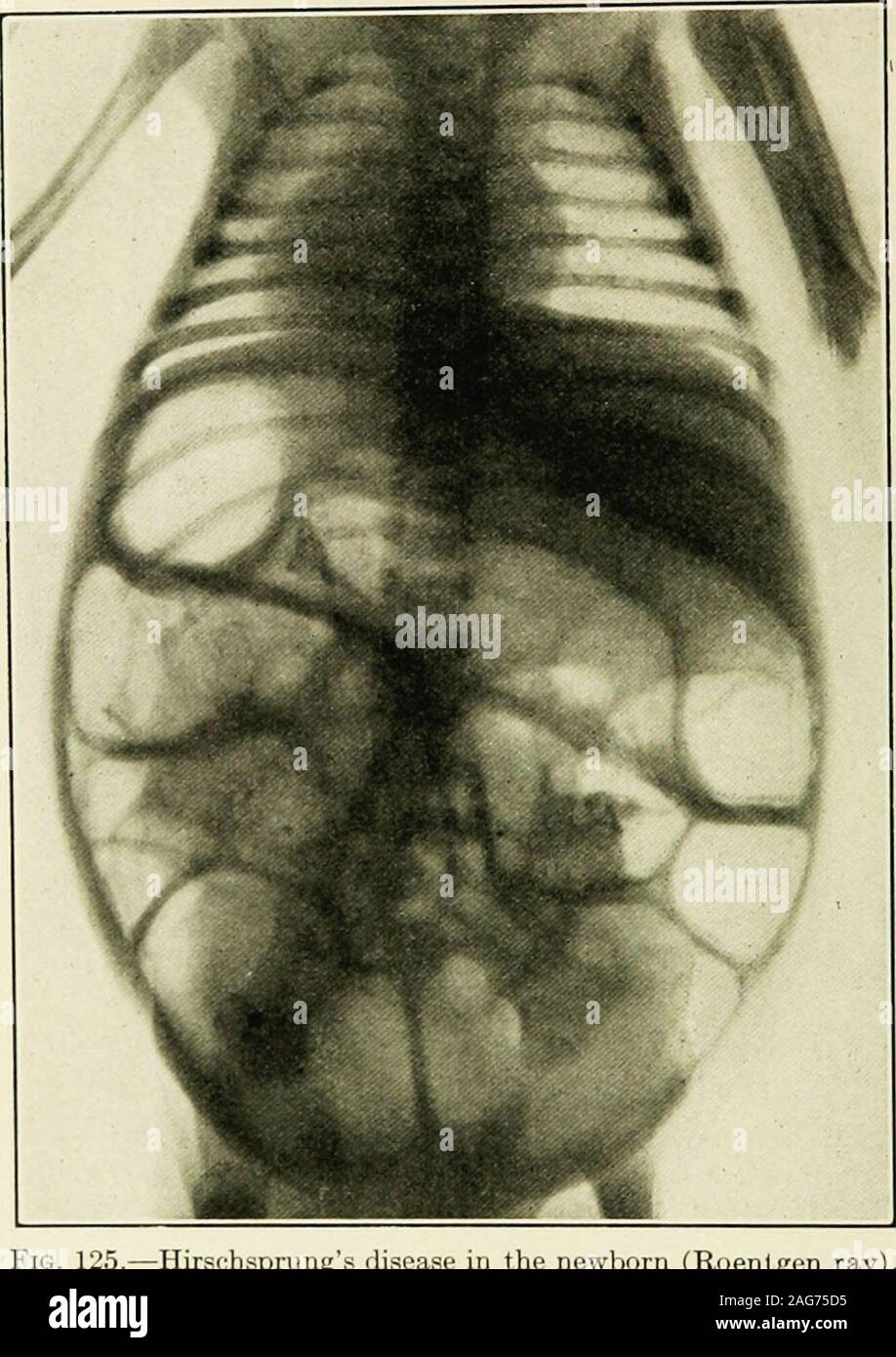 Perforazione dell'intestino immagini e fotografie stock ad alta risoluzione  - Alamy