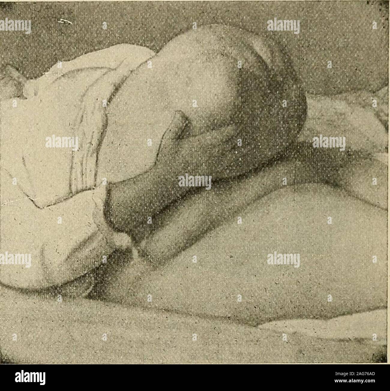 . La moderna chirurgia generale e operativa. s più frequentin enteroceles rispetto a epiploceles. È più comune quando il hernialorifice è piccola ed è visto raramente in grandi rotture.^ strangolamento è rarein infanzia. Strangolamento è molto più pericoloso quando è di intestino presentin sac rispetto a quando omento solo è presente. Se in un soggetto di ernia theabdominal pressione è aumentata bruscamente, come da una violenta tosse o muscularefifort, la erniaria orifizio è dilatata per un momento, più intestino o omentummay immettere il codice degli aiuti alla siderurgia, e se non lo possono essere catturati e strozzata dail ora strozzata hern Foto Stock