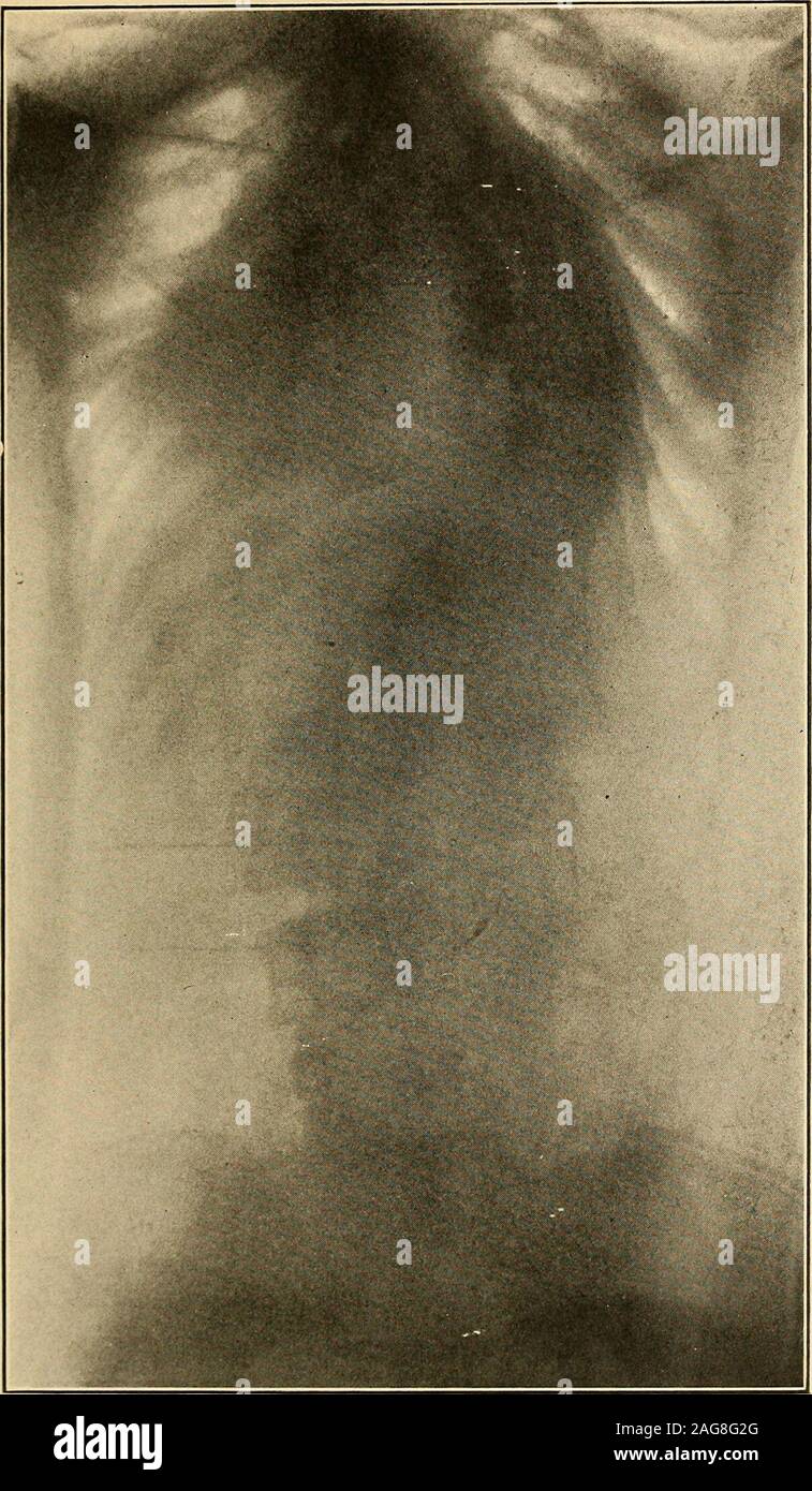 . La chirurgia ortopedica per studenti e medici di medicina generale : Considerazioni preliminari e patologie della colonna vertebrale : 114 illustrazioni originali. la colonna vertebrale; thescapula oltre la convessità è più concava e che lungoil concavità è più appiattita rispetto al normale. Il torace è quindi necessariamente molto distorta lungoil curva convessa nella parte posteriore dove il progetto di nervature o bulgeabnormally indietro, mentre sul lato opposto è flat-tened o scavati. (Fig. 94.) davanti la retromarcia occursand in ragazze più grandi la mamma corrispondente con il concaveside della dorsale curva è più pr Foto Stock