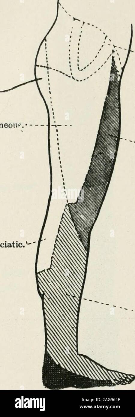 . Terapia medico-chirurgica. Cutaneo esterno. Piccola "fiiatio. ?Popliteo esterno. Popliteali interna. La fio. 70.-sensoriali periferici distribuzione della estremità inferiore(aspetto posteriore). Il peroneus hrevis rapisce e everts il piede. Infine, l'estensore hrevis digitorum assiste l estensore longus,e si estende le prime falangi delle prime quattro dita. Muscoli fornito dall'interno del nervo poplitea.-l'popUtetismuscle si flette la gamba sulla coscia. Il plantaris è molto incostanti e non ha alcuna azione speciale. Il gastrocnemio e il soleus si uniscono per formare un singolo muscolo,i tricipiti o Foto Stock