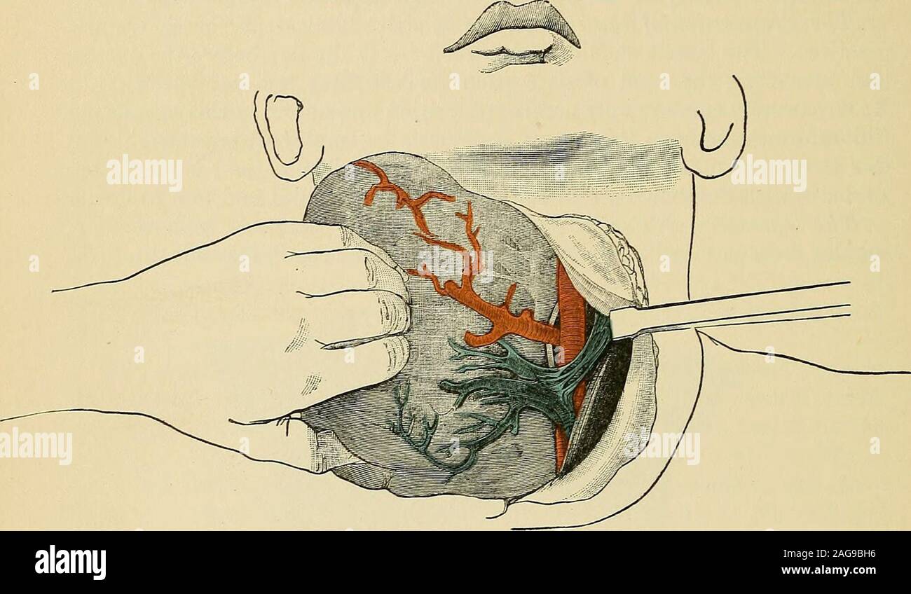 . Intervento chirurgico. anteriore e giugulare esterno vene, i. Sterno-cleido-muscolo mastoide, c. Sterno-muscolo della tiroide, d. Anteriore vena giugulare. e.Sterno-hyoid muscolo e di struttura semplice e di guadagno di cosmetici sia importante fare una incisione liberaltransverse con una leggera convessità verso l'alto lungo la linea di cleav-età della pelle, attraverso la maggior parte prominente del tumore, attraverso theintegument e platysma, tra le frontiere esterne dell'sterno-mastoidmuscles (Fig. 882), catturare i vasi superficiali e dividendo thembetween due legature; dividere lo scudo ed esporre la diffusione-out fibe Foto Stock