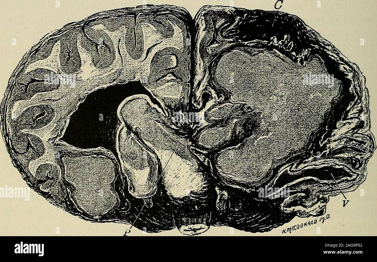 . Un trattato sulle malattie del sistema nervoso dei bambini : per medici e studenti. f meningi, o almeno vicino la corticale vasi sanguigni.i vasi sanguigni indiscutibilmente gioca una parte importante per i casi di tubero- 570 LE MALATTIE DEL SISTEMA NERVOSO DEI BAMBINI. cular meningite della base piccoli tubercoli di un pin-dimensione della testa può essere seenscattered lungo i vasi sulla superficie esterna del cervello. Un solitarytubercle è composto da una spessa dello stroma con cellule giganti e una considerableamount di duro tessuto fibroso. Vi è una più o meno concentrico organizzare-mento delle parti, e la porzione centrale 0 Foto Stock