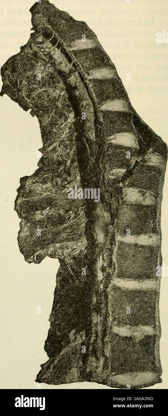 . La moderna chirurgia generale e operativa. Fig. 609.-frattura della cervicalspine, cavo compresso da ossa e sangue.emorragia in corda presso la sede della lesione e al di sotto della lesione CWarrenMuseum). (Da Scudders Treatmentof fratture. Disegnata da Byrnes.) Fig. 610.-colonna vertebrale sawed. Iraciure di processi thespinous della settima vertebra cervicale euna prima e seconda vertebre dorsali. Fractureof i corpi del quinto, sesto e vertebre seventhcervical con spostamento backwardof il frammento superiore. La frantumazione totale di thecord. La sezione passa un po' su di un lato della corda, che è visibile in luogo di un Foto Stock