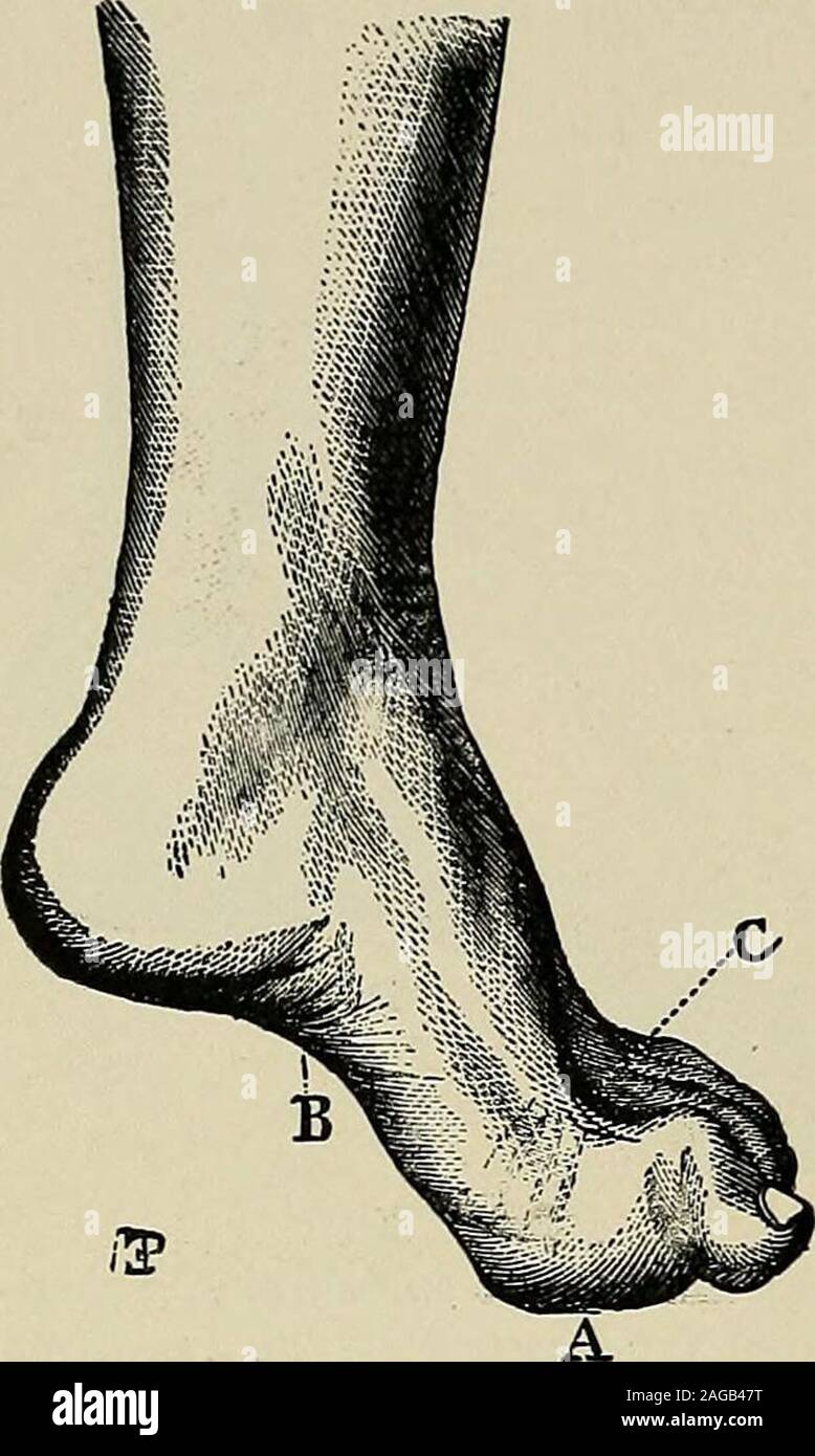 . Un trattato sulle malattie del sistema nervoso dei bambini : per medici e studenti. Fig. 23.-superficie plantare Fig. 24.-stesso piede. Fig. 25.- artigliato dal piede del piede stesso, presentano-ing cambia a causa della Con-tracture di PeroneusLongus, accorciando ofTransverse diametro AC e torsione del piede. Posizione valgo dovuto toSame causa. Atrofia Interossei OtherIntrinsic e muscoli del piede. (Du-chenne.) 32 LE MALATTIE DEL SISTEMA NERVOSO DEI BAMBINI.. Fig. 26. - Pes Equinus in un BoyFive anni di età da Atropliyof Anticus tibiale. Foto Stock