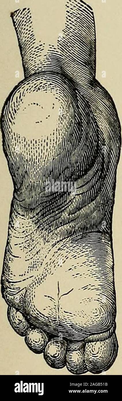 . Un trattato sulle malattie del sistema nervoso dei bambini : per medici e studenti. Fig. 21.-Submetatarsal preminenza. ALower rispetto al normale e IncreasedPlantar Arch, risultante dal contratto-ura di Peroneus Longus. Fig. 22.-presentanti, in aggiunta, Promi-nence del tendine del PeroneUsLongus F. (Duchenne.) C 1^. Foto Stock
