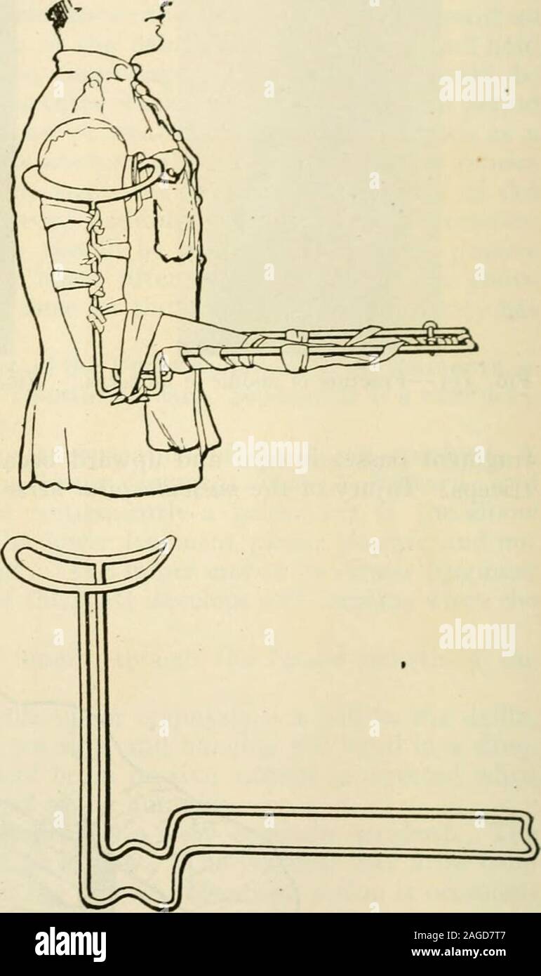 . La moderna chirurgia generale e operativa. Fig. 356.-modificato Thomas splintused dai principali Robert Jones in casesof frattura dell'omero (scafo). Fig. 357.-Jones omero stecca di trazione. L'American pattern del fissatore è qui illustrato. Bychanging il modello della stampella ascellare il splintis reso adattabile a entrambi i lati del corpo. Byslightly allungando il pezzo dell'avambraccio, trazione sullato avambraccio può essere ottenuto (Osgood). mancanza di fissazione della spalla-giunto, e imperfetta supporto gomito. Hamiltonbelieves che esso è dovuto al fatto che il gomito diventa presto fissata al bene dell'angolo, e Foto Stock