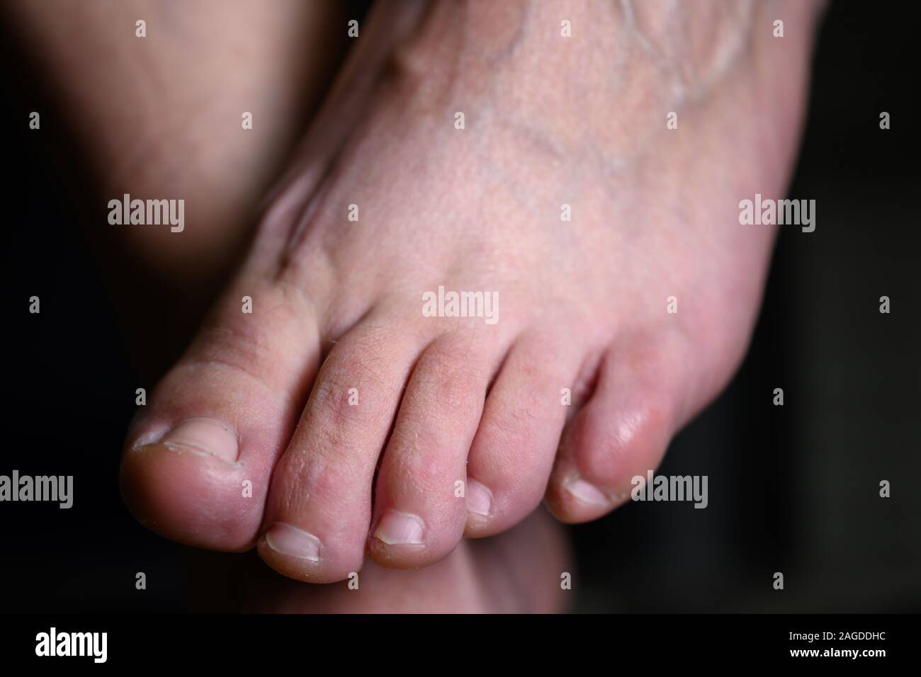 Close up di disonore donna nascondendo la sua altlete di piede di infezione da funghi. Puzzolente weaty piedi portando una malattia infettiva Foto Stock