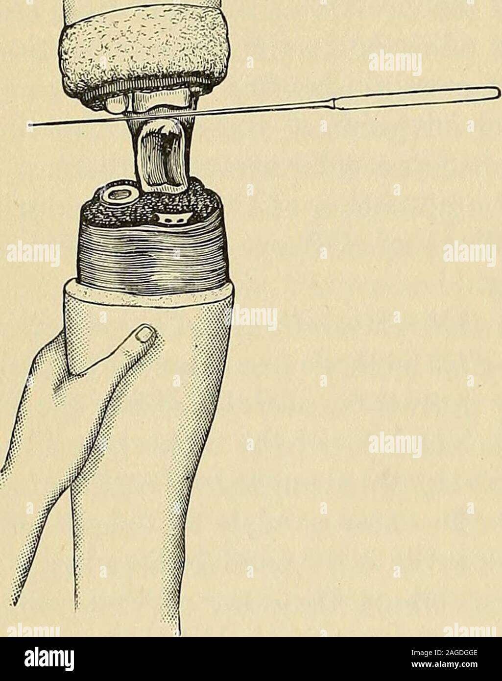 . Intervento chirurgico. Fir. 535.-l'ellip-tical-metodo di aletta. 482 chirurgia operativa. a raccomandare questo piano al posto dell'ex. In questo amputazione adrainage tubo dovrebbe essere impiegato per i primi giorni di trattamento. Il metodo circolare.-stendere i lembi obliquamente, la misurazione da thecondyles-quattro centimetri sotto la superficie esterna e due e una metà pollici sotto condilo theinner. Dividere i tessuti superficiali obliquamente verso il basso per lo scudo. Foto Stock