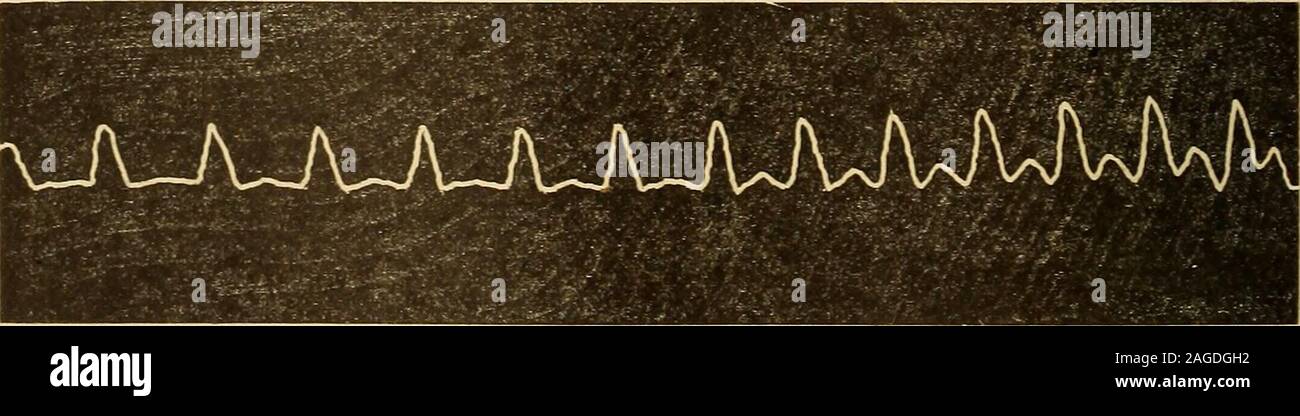 . Un libro di testo sulle malattie mentali, per l'uso degli studenti e dei professionisti della medicina. Sphygmogram Xo. G. L'impulso-tasso in questo esempio era di 72 e la pressione di due once. È stato un casodi mania cronica con tensione di impulso, spesso presente in questa forma di disturbo mentale.Vi è una bassa percussione-wave e una discesa con tutte le caratteristiche usuali oscurata, andstill è una traccia molto comune nella mania cronica.. Sphygmogram Xo. 7. Questo tracing in epilessia mania, con un impulso di 120 e due once di pressione, illus-trates un interessante varietà cf a bassa tensione impulso dicrotic con salita verticale, ac Foto Stock