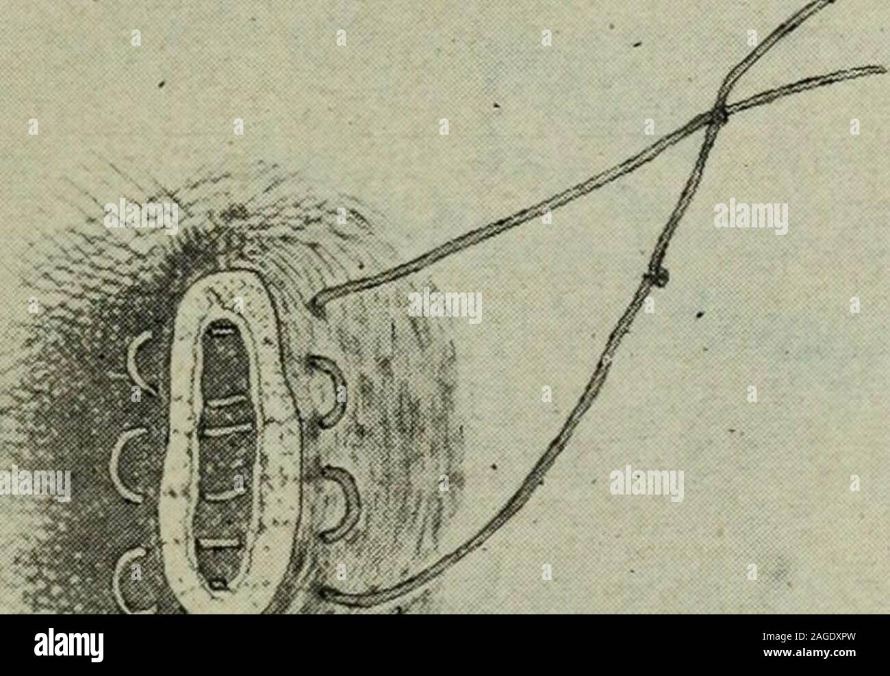 . Plexus. Gie. 4-la sutura dello strato superficiale. #. Fig. 5.-la sutura del sac. La sutura della parete addominale. 41 " il frontalino dal bordo di4avvolto e tirate saldamente fino lacoppia di nodo e la ferita è chiusa dal continuo aringa-bonesuture. All'ultimo punto di cucitura il filo di sutura è shirred tenuta,afferrata da una punta liscia forcipe di dissezione in corrispondenza della sua uscita dal recinto scudo, e un altro reverse bow-knot legata al di sotto del punto della pinza. Con la pratica, questo può essere fatto senza un lasco particleof essendo lasciato in la sutura. Essa può essere legata in questo modo asclosely come nel metodo ordinario della legatura Foto Stock