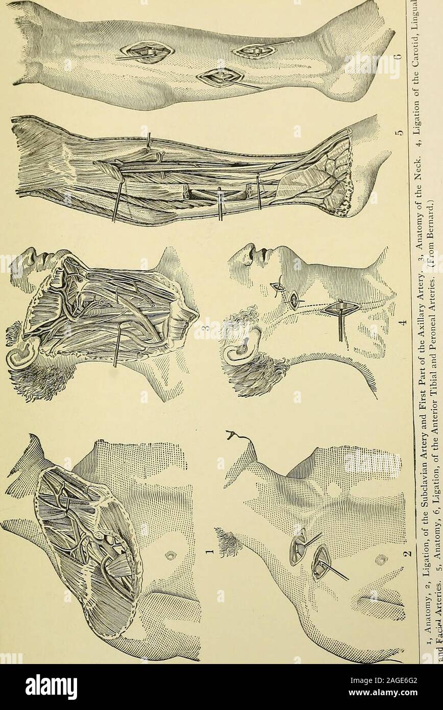 . La moderna chirurgia generale e operativa. Fig. 281.-posizione delle linee di incisione oftemporal, del viso, lingue, carotide comune (rispettoal omohyoid), succlavio ascellari (prima parte),e interna delle arterie mammarie (MacCormac). Ligazioni. La piastra 5. -•^ffni. Arteria vertebrale 547 vena succlavia è su un piano inferiore tlian l'arteria. L'arteria è sentita beatingas esso giace sopra la nervatura. L'arteria è cancellata e il cavo di abbassamento del brachialplexus è esposta. La vena deve essere custodita con il dito e l'ago ispassed dall'alto verso il basso, come il plesso, che è più in pericolo di thevein, è Foto Stock