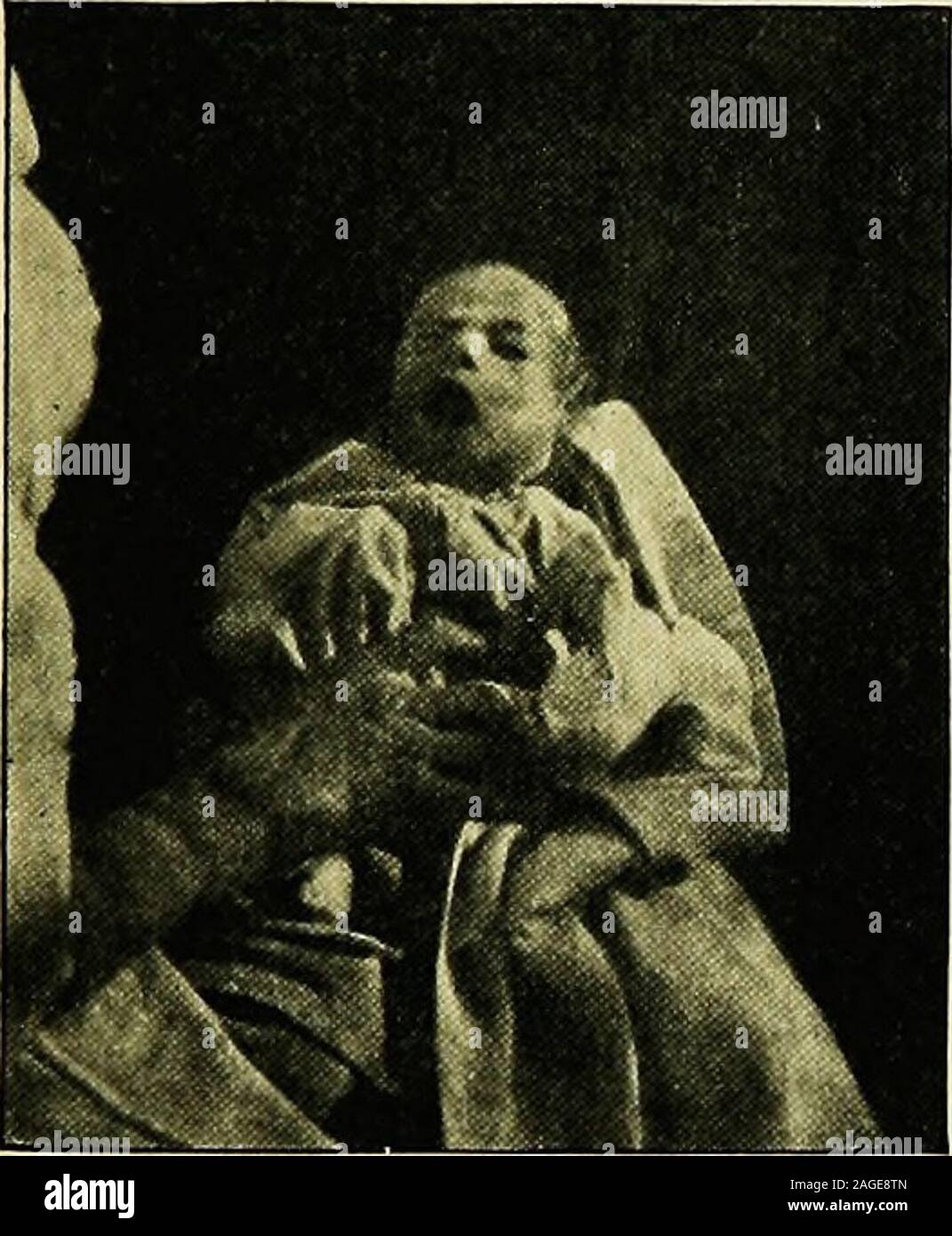 . Case histories in pediatria. : Una raccolta di storie di pazienti reali selezionati per illustrare la diagnosi, prognosi e trattamento delle più importanti malattie dell'infanzia e della fanciullezza. Movimenti passivi non sono stati limitati. Thearm non è stata offerta e non vi sono state testimonianze di dislocazione fractureor. Il braccio sinistro e le gambe erano normali andshowed segni di spasmo o paralisi. Il knee-wereequal a scatti e vivace. Non vi era alcun segno Kcrnigs. Vi wasno allargamento dell'i linfonodi periferici. Il rectaltemperature era normale. Malattie DEL NUOVO NATO. 15 diagnosi. La diagnosi di Foto Stock