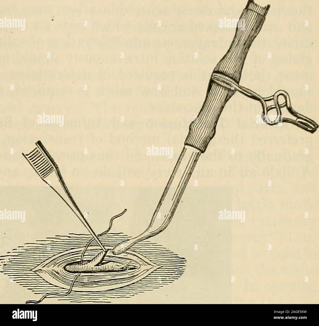 . La moderna chirurgia generale e operativa. -2 pinta a 2 pinte oreven più sono lentamente in-jected, la condizione del paziente determinando la quantità determinata. In un caso di emorragia violenta theauthor utilizzati oltre 2 quarti. Al fine di infondere questo fluido legare un filetto ben rispettoal gomito e esporre attraverso la dissezione della mediana Vena basilica, o la Vena basilica nel tratto del suo corso dove esso è superficiale per la fascia profonda. Legare la vena.. Fig. 272.-per via endovenosa per infusione di soluzione salina. Modo ofincising vena e inserendo il tubo di vetro (SENN). Foto Stock