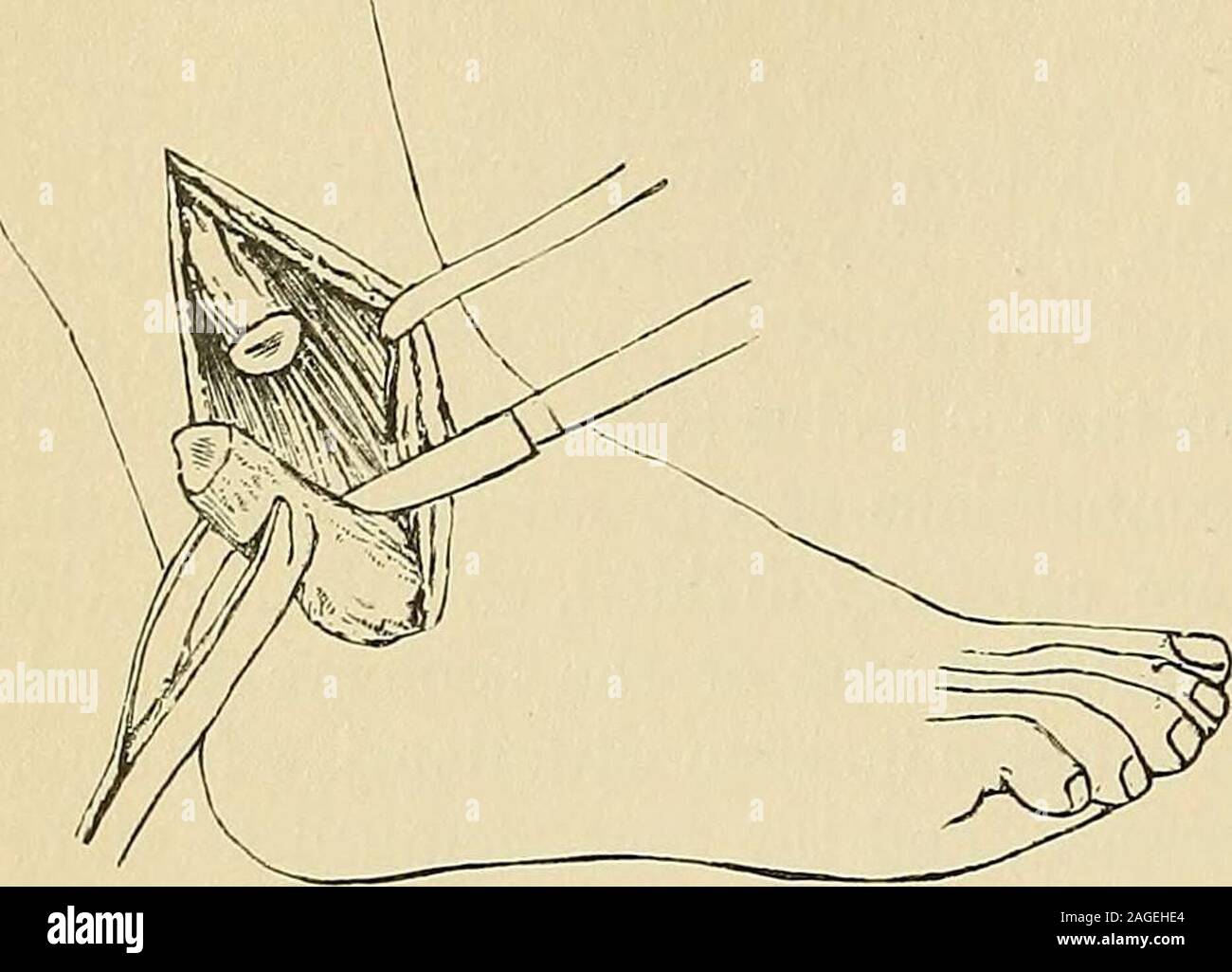 . Intervento chirurgico. Fig. 426.-lato esterno della caviglia, a. Tendo Achilis. b.Peroneus longus. c. Peroneus brevis. d. Peroneustertius. e. Il malleolo esterno. /. Estensore longusdigitorum. g. Legamento cruciale. h. Extensorlongus pollicis. 412 INTERVENTO CHIRURGICO. Maiale. 427.-Removinar estremità inferiore del perone. sferico e le membrane sinoviali sono questioni di speciale importanza in exci-Sion. I punti di riferimento del giunto sono indicati sotto la considerazione di am-putations in corrispondenza della caviglia (pagina 509 etseq.). Le indicazioni per chiedere la oper-zione sono numerosi e dovrebbe bewell considerato prima di tentare-ed. Come Foto Stock