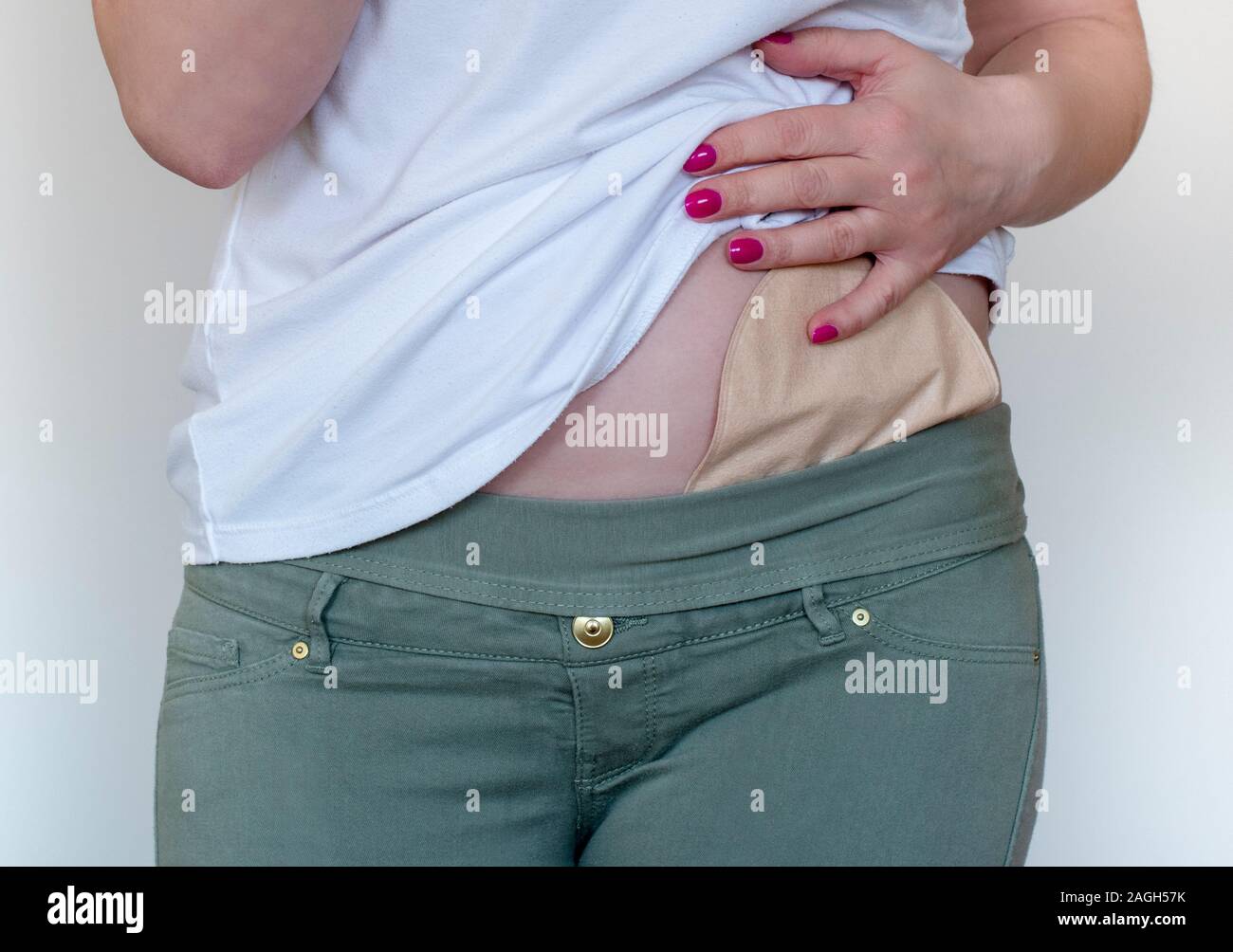 La colostomia borsa in pelle di colore attaccata alla giovane donna paziente. Close-up sulla tasca per ostomia dopo la chirurgia del colon. Tema medico. Colon cancer treatment Foto Stock