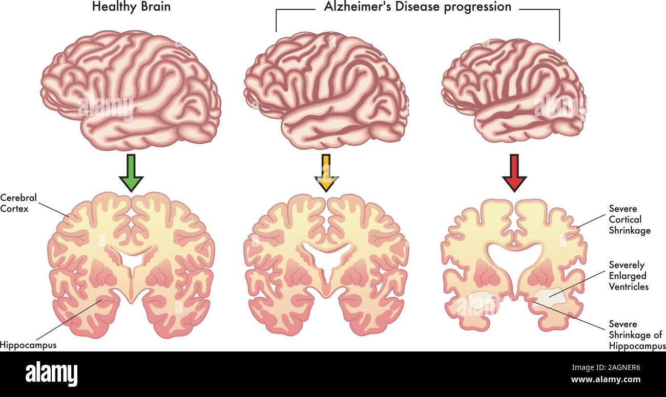 Illustrazione medica dei sintomi della malattia di Alzheimer di progressione. Illustrazione Vettoriale