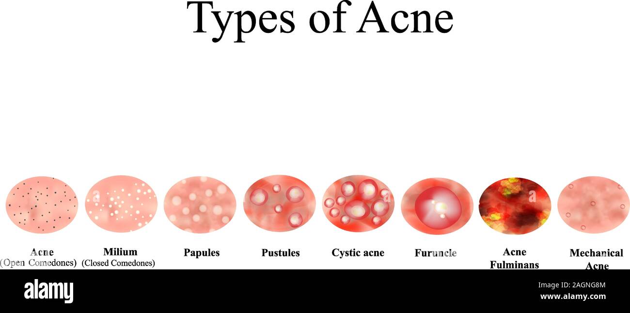 Tipi di acne infiammazione della pelle. Brufoli, bolle, Whitehead, comedoni  chiusi, papule, pustole, acne cistica. Infographics. Illustrazione  Vettoriale su Immagine e Vettoriale - Alamy