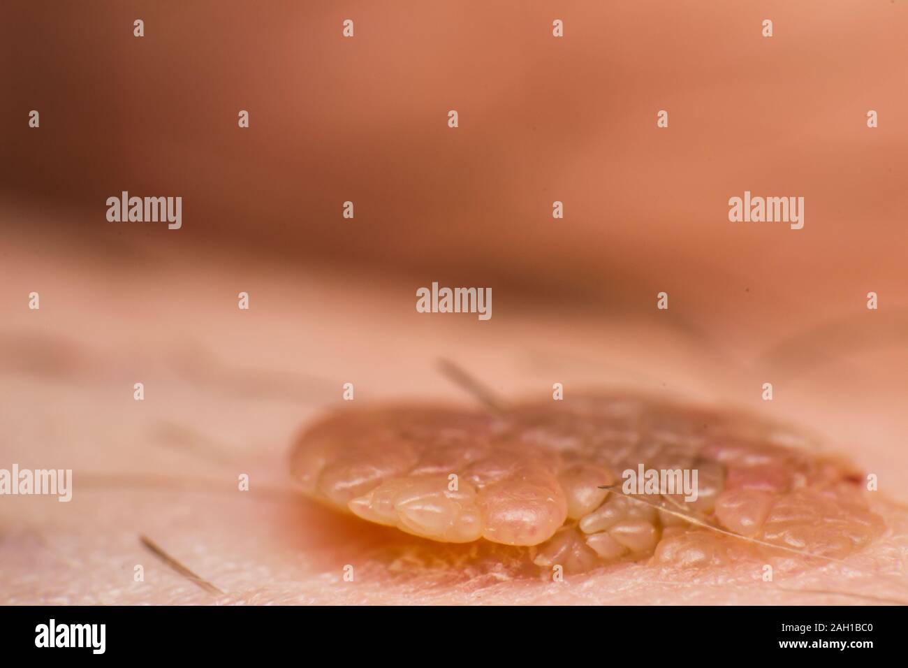 Foto macro di una pelle verruca, papilloma virus infezione Foto Stock