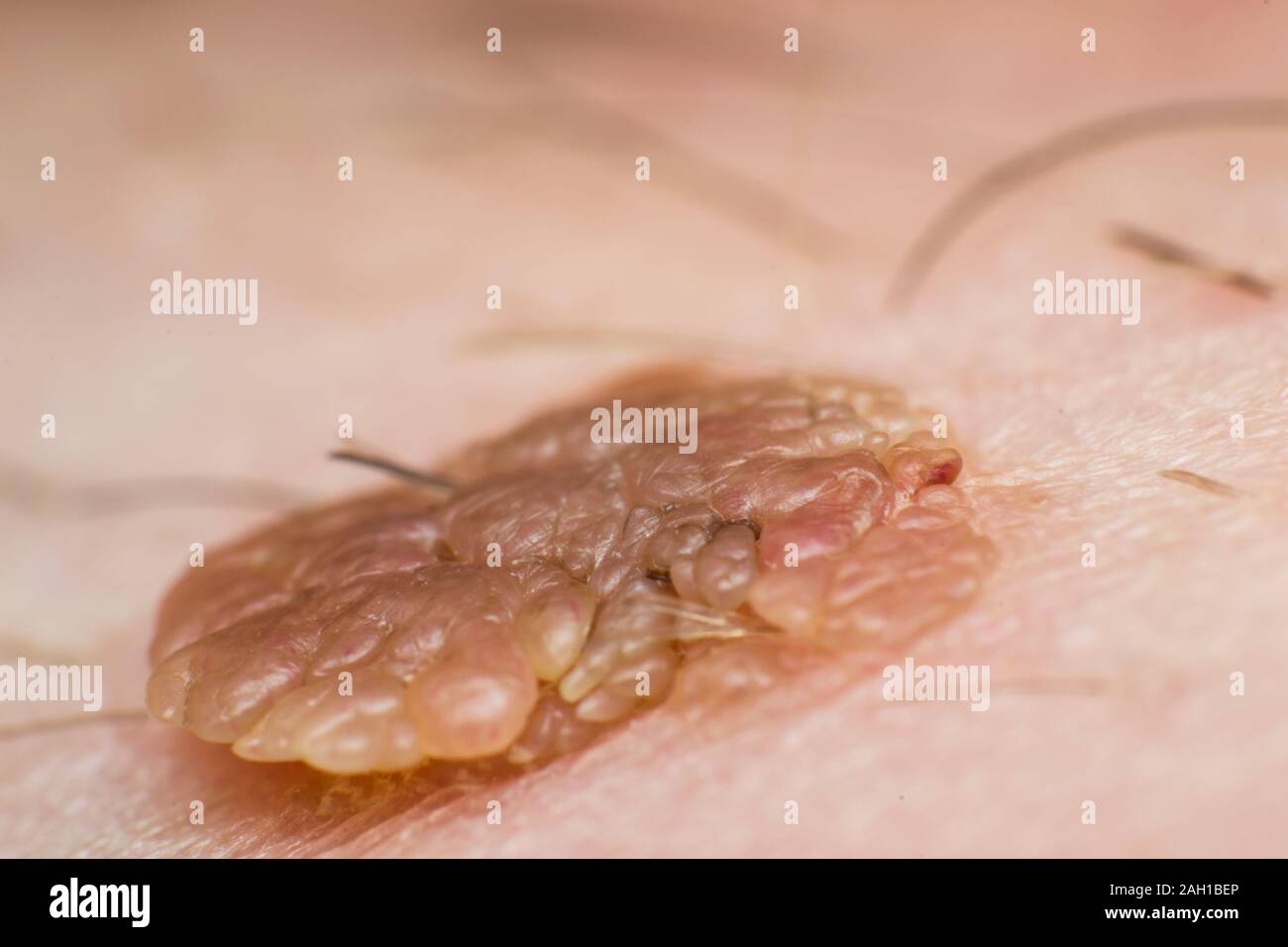 Foto macro di una pelle verruca, papilloma virus infezione Foto Stock