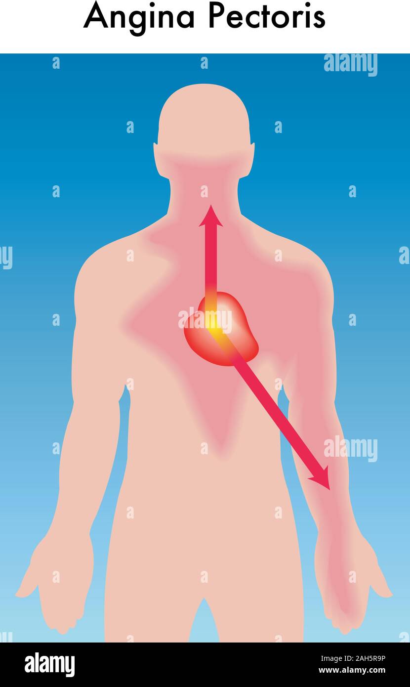 Medical illustrazione che mostra i sintomi di un attacco di angina pectoris. Illustrazione Vettoriale