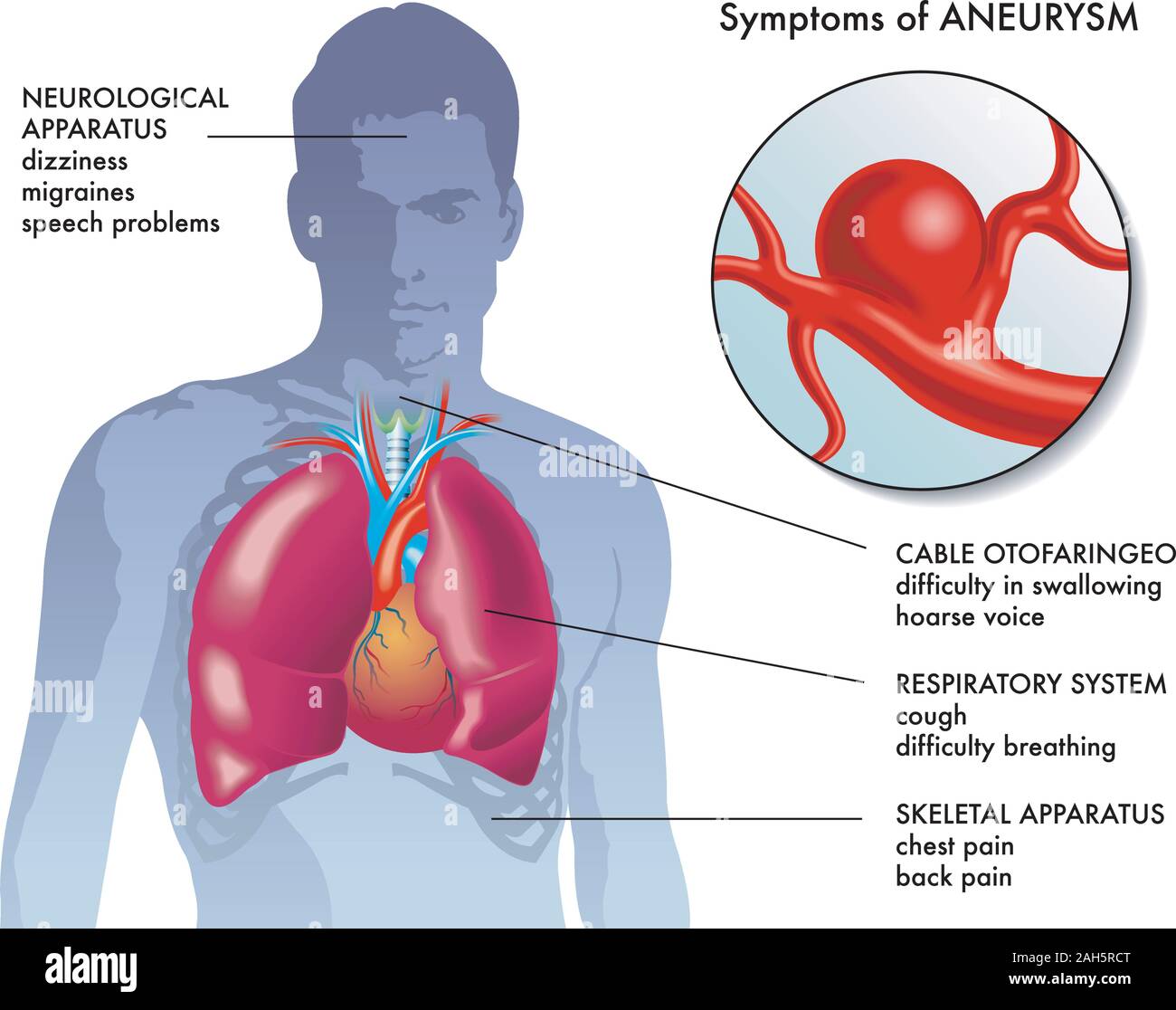 Illustrazione medica dei principali sintomi di aneurisma. Illustrazione Vettoriale