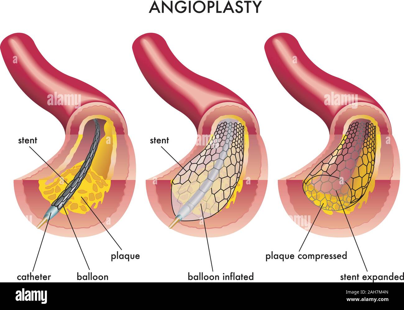 Illustrazione medica di un'operazione di angioplastica. Illustrazione Vettoriale