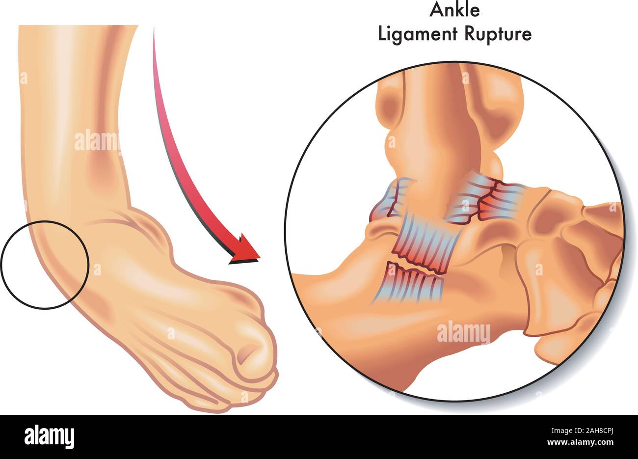 Illustrazione medica della caviglia rottura del legamento. Illustrazione Vettoriale