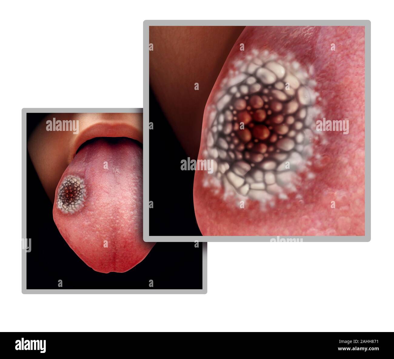 Linguetta di cancro concetto medico o carcinoma a cellule squamose come tumore maligno malattia in bocca. Foto Stock
