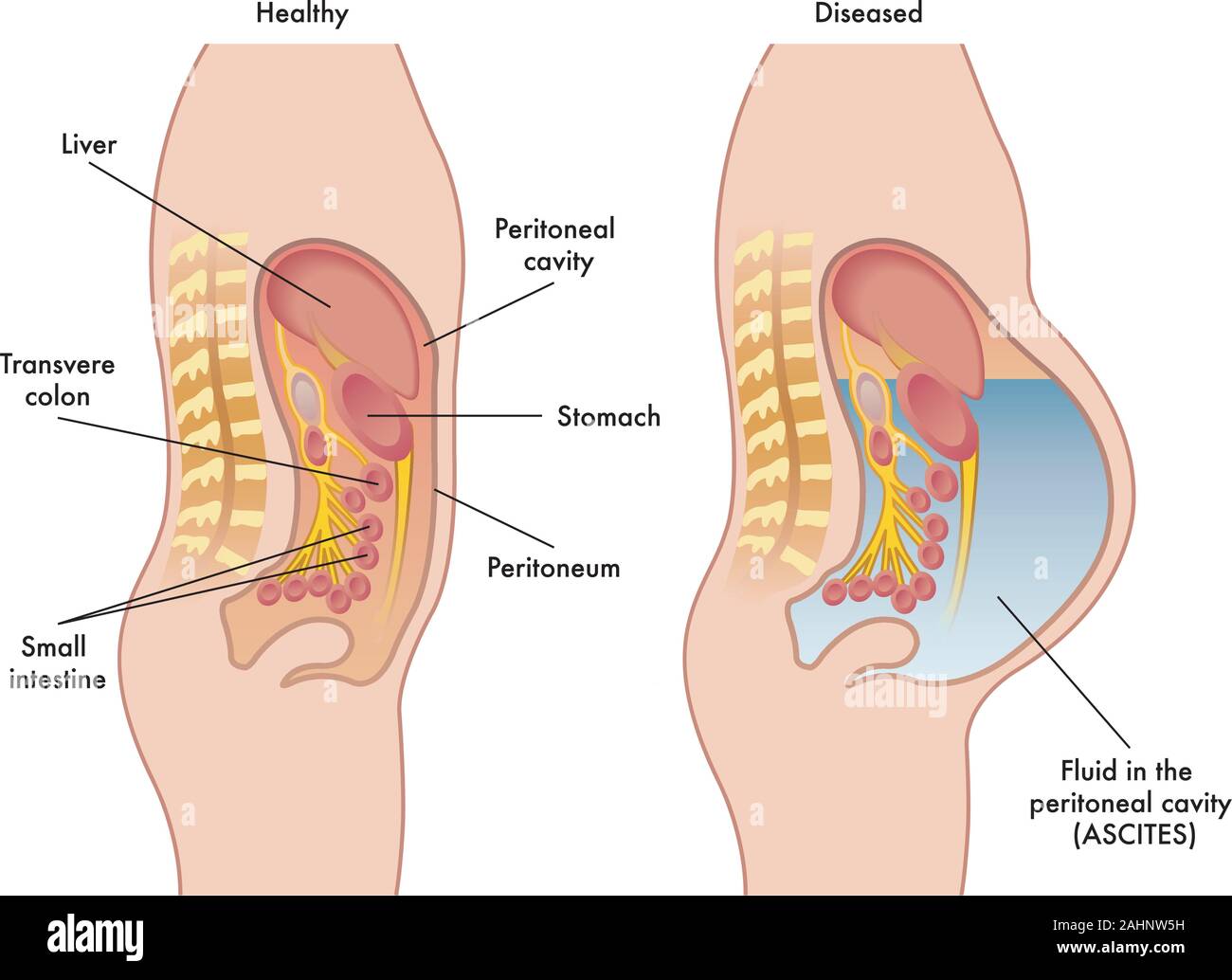Illustrazione medica dei sintomi e le conseguenze di ascite. Illustrazione Vettoriale