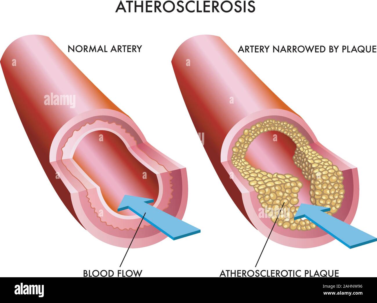 Illustrazione medica degli effetti di arteriosclerosi Illustrazione Vettoriale