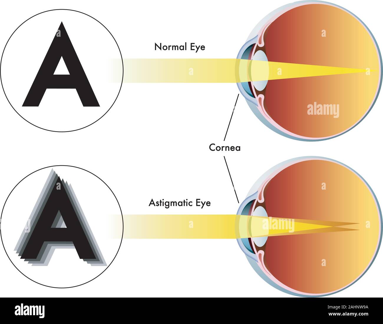Illustrazione medica dei sintomi di astigmatismo Illustrazione Vettoriale
