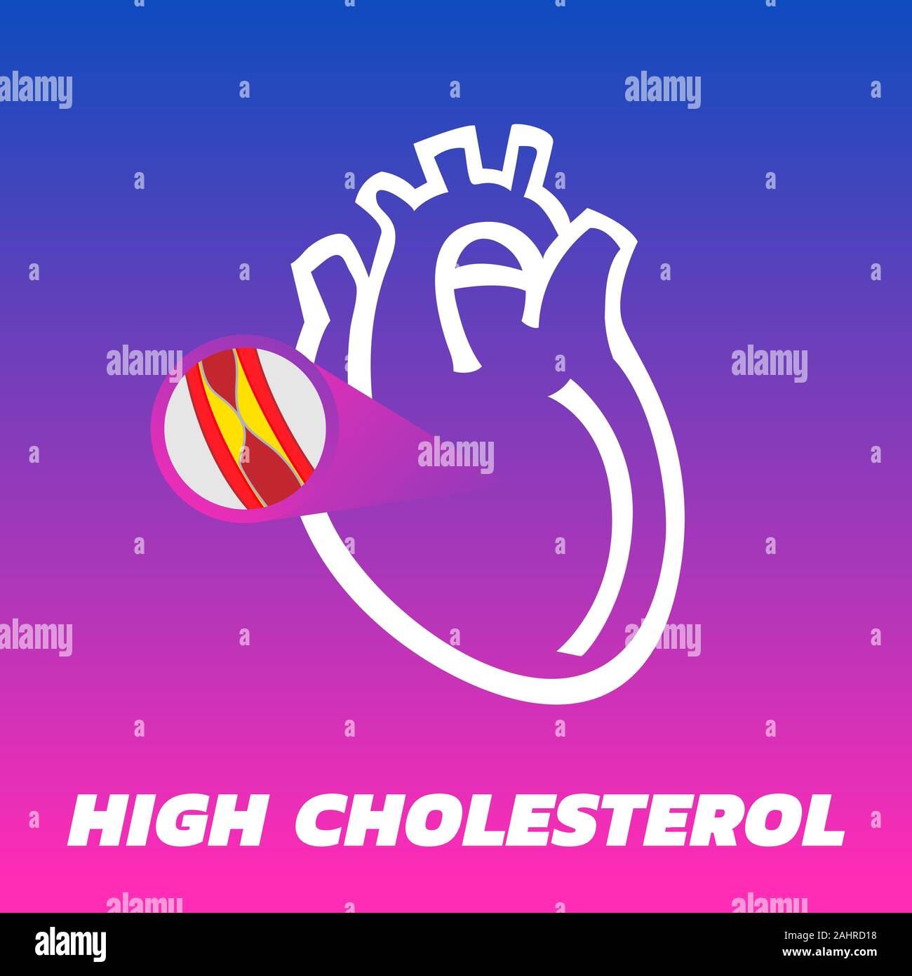 Colesterolo alto vettore logo icona Illustrazione Vettoriale