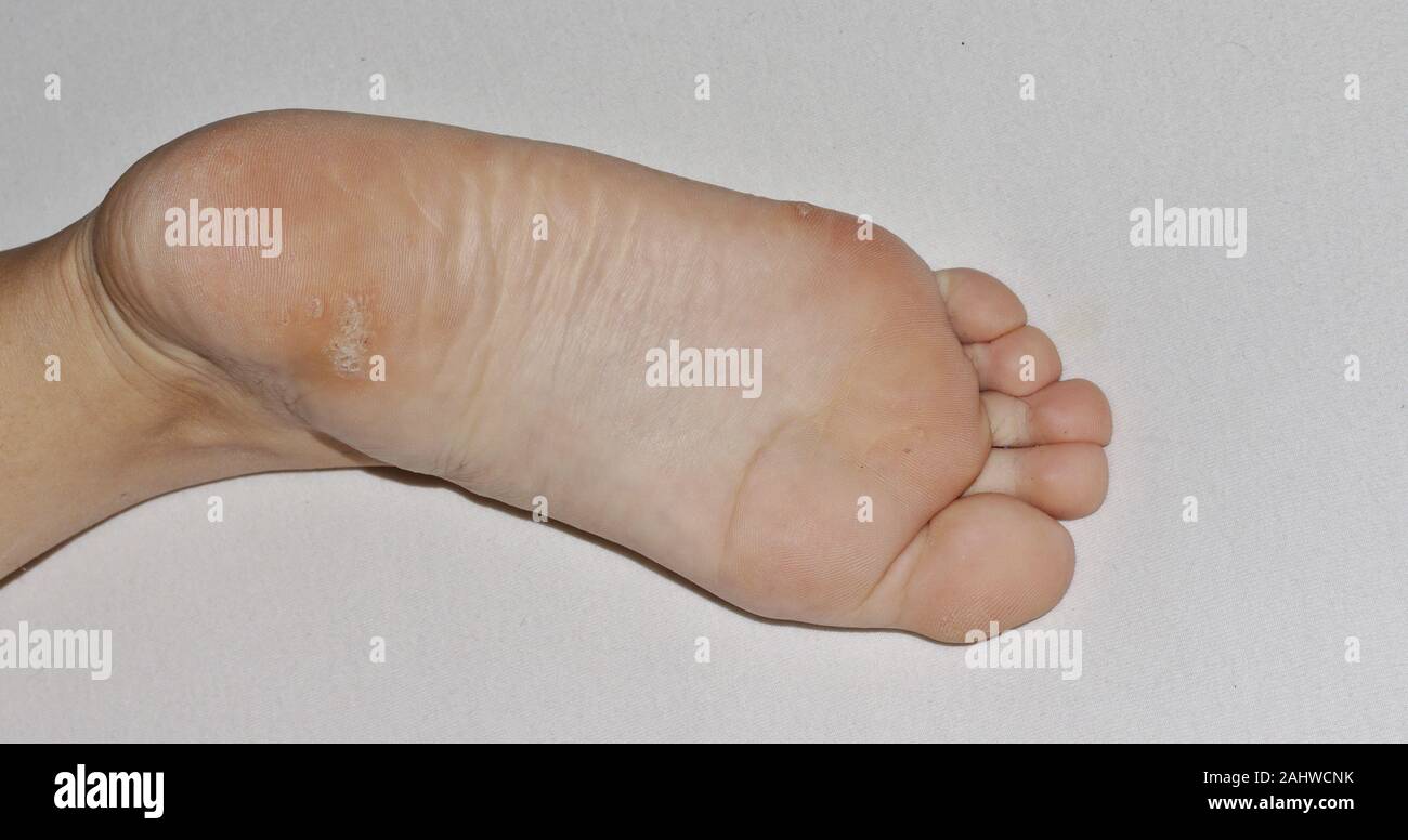 Inquadratura ravvicinata di una verruca plantare sul fondo di un tallone del piede causata dal papillomavirus umano o HPV. Foto Stock