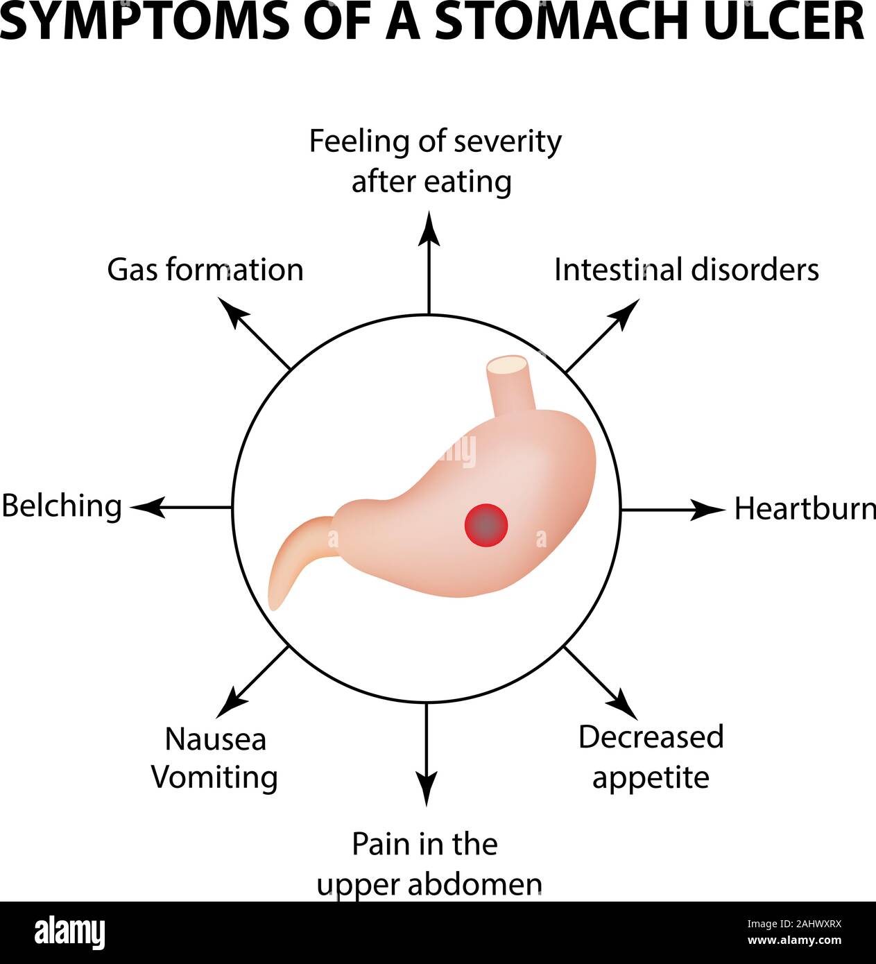 I sintomi di un'ulcera dello stomaco. Infographics. Illustrazione Vettoriale su sfondo isolato Illustrazione Vettoriale