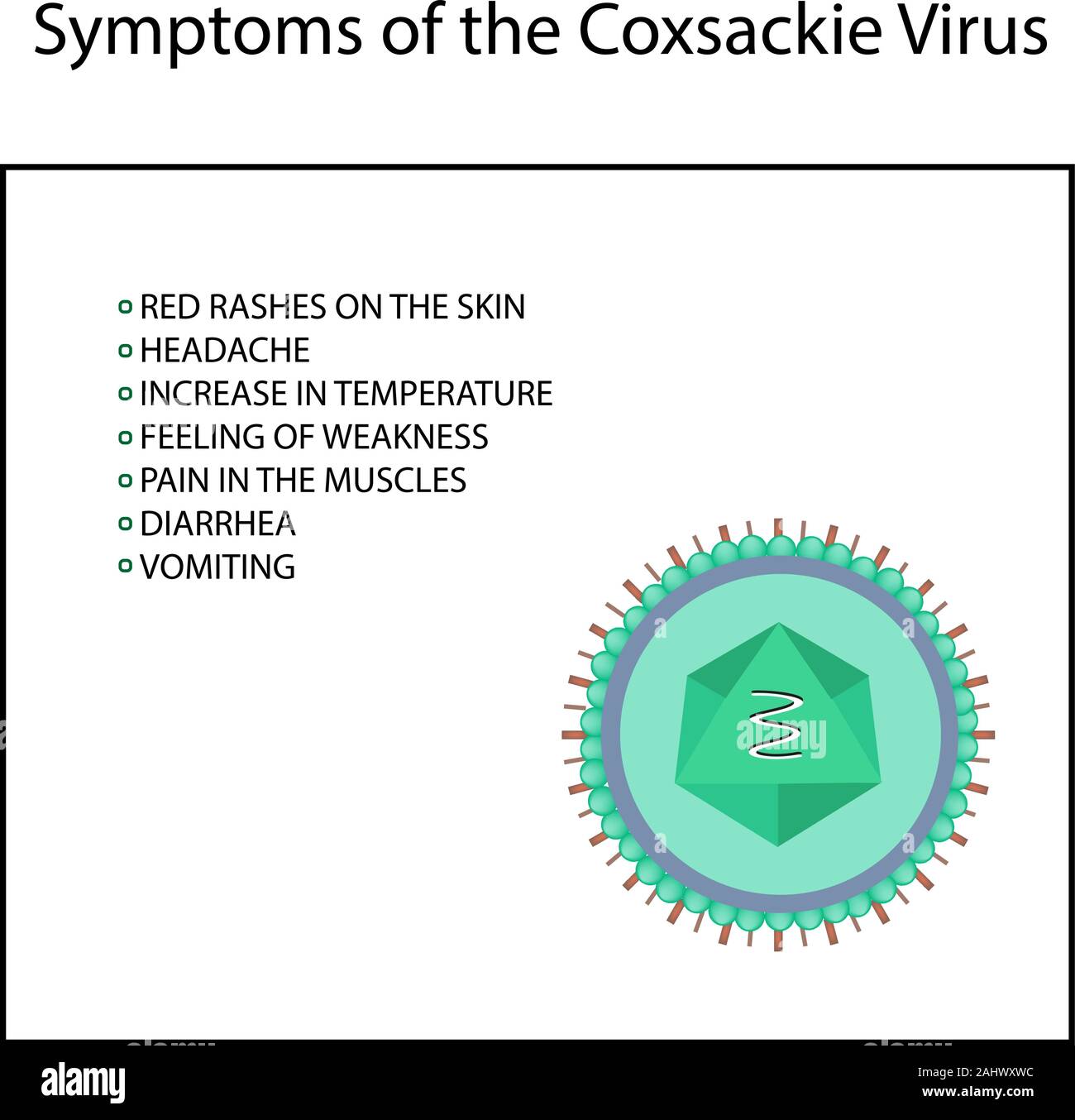 Sintomi di infezione coxsackie virus. Enterovirus. Infographics. Illustrazione Vettoriale su sfondo isolato Illustrazione Vettoriale