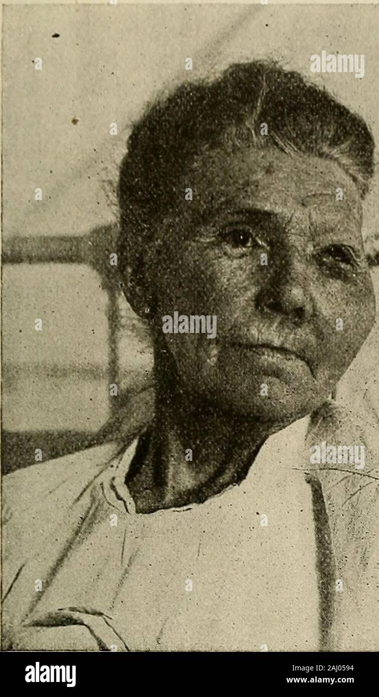 La moderna chirurgia generale e operativo . lontano fuori dalla bocca. Questa condizione di tongueenlargement è dovuta a lymphangioma della mucosa. Lymphscrotum è dovuta ad una simile crescita. Una raccolta di questi presenta verrucosa-cercando dila-tation è chiamato lymphangiectasis. Proprio come angiomata cavernoso constitutea varietà di vaso sanguigno tumori, in modo cavernoso costituiscono lymphangiomata avariety dei linfonodi-nave tumori, e gli spazi di questi ultimi vengono riempiti withlymph anziché con il sangue (Figg. 186 e 187). Le aree interessate con la linfa-1 Cheyne e Burghards Manuale del trattamento chirurgico. Connettivo maligne- Foto Stock