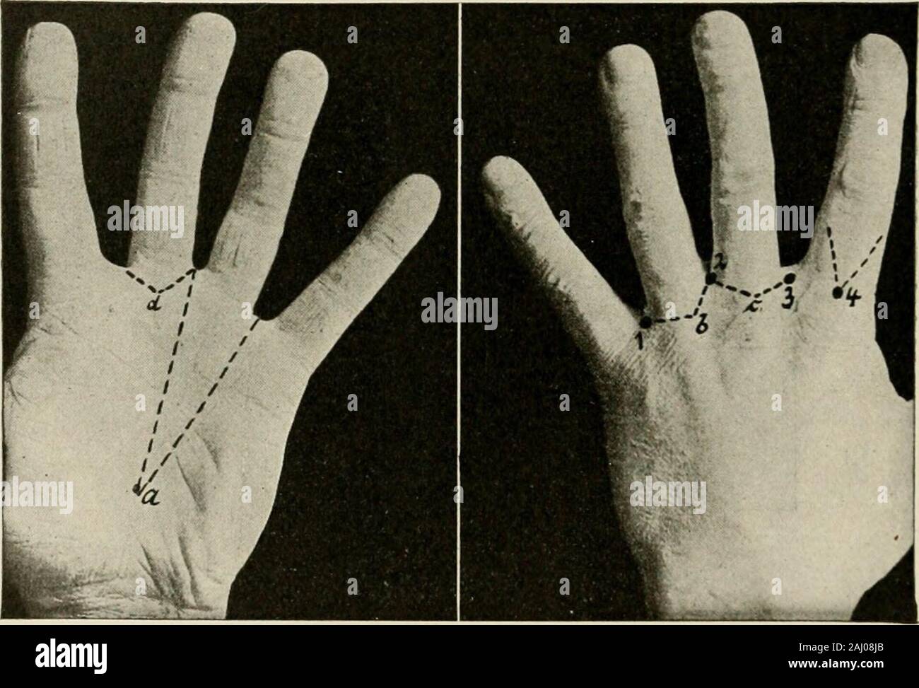 Gli enti locali e regionali; anestesia con capitoli su spinale, epidurale, paravertebral e parasacral analgesia e altre applicazioni locali e regionali di anestesia per la chirurgia dell'occhio, orecchio, naso e gola, e alla pratica dentistica . artfna digitalis/volans roinmiinis Fig. 41.-una vista laterale dei nervi e vasi del index-dito. (Sobotta e McMurrich.). Fig. 42.-punti di iniezione e linee di infiltrazione in funzione a seguito si attarda e mano. (Da Braun). Foto Stock