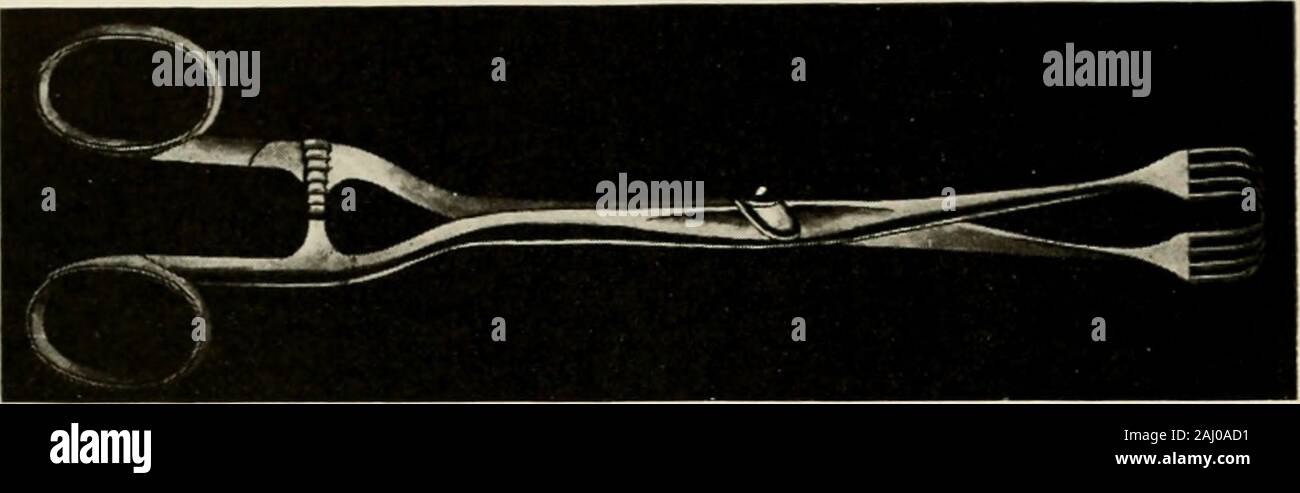 La castrazione degli animali : un libro per l'uso degli studenti e dei professionisti . Fig. 55-un ben sviluppato Schirrous cavo. Se af fine di sei settimane il tumefaction persiste, quindii radicale-che consiste nella ablazione totale-è-justi depurato e infatti indicato. Moderazione-^ame come per ridgiing castrazione, vedere pagina 54. Posizione-dorsale. Anestesia generale è sempre indicato quando possibile, come funzionamento è estremamente doloroso e solitamente prolungata per un con-siderable lunghezza di tempo al fine di emorragia di controllo. Strumenti, ecc.- 1. Ecraseur (Figg. 5, 6, 7 e 8). 2. Aghi filettati per Foto Stock