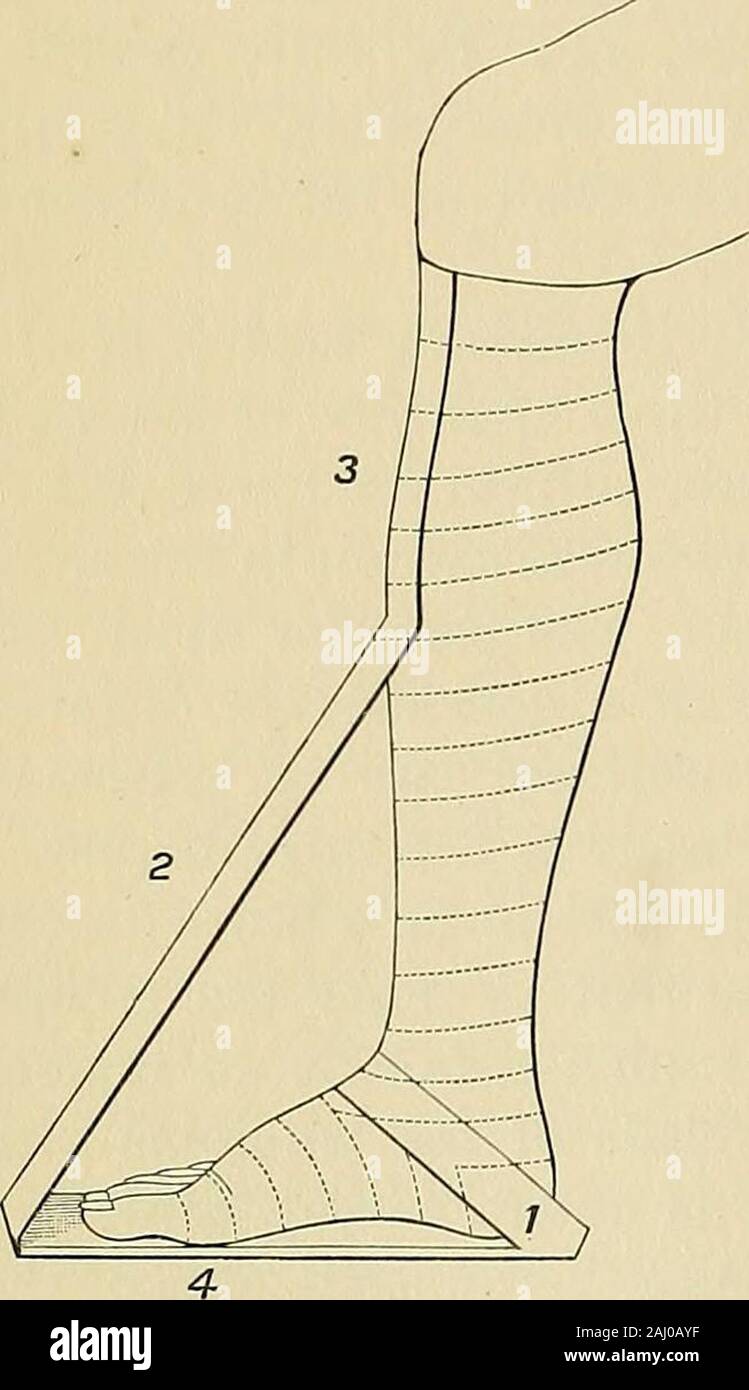 Intervento chirurgico . influenze di formazione non dovrebbe essere employeduntil tre o quattro giorni più tardi. La divisione dei tendini del per-oneus Longus e Brevis muscoli.-Thetendons di questi muscoli passano in un commongroove dietro il malleolo esterno e areinclosed dalla stessa guaina, la brevis pass-ing il più anteriormente. Il peroneus brevisleaves il suo compagno dopo passando dietro il mal-leolus, ed è inserito nella base del themetatarsal osso del mignolo al outerside. Il peroneus longus, dopo il passaggio di essere-hind del malleolo, guadagna la pianta del piede,entra il calcaneo-cuboide g Foto Stock