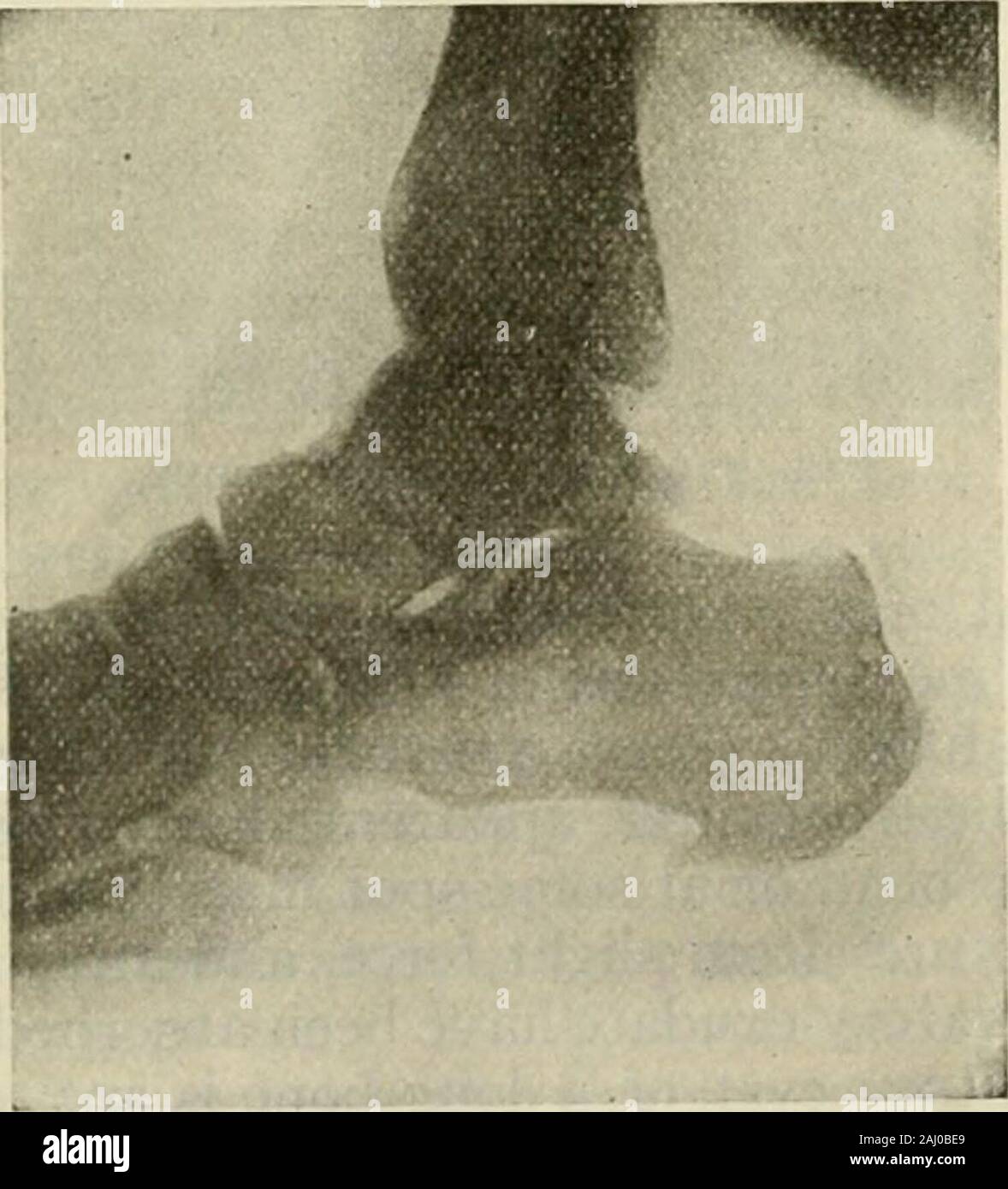 La moderna chirurgia generale e operativa ci .. In un normale chondroma incidere la capsula e prendere via la crescita, utilizzando scalpelli e sgorbie senecessario. Rimozione incompleta meansinevitable ricorrenza. Amputazione isvery raramente richiesto. In chondro-sarcoma incisione devono essere al di fuori di thecapsule. Corpi allentati nelle articolazioni, ifproductive di molto fastidio sono a rimosso il giunto essendo aperto conla più rigorose cure antisettico. Amputationis talvolta eseguita per un solitario cystof un osso lungo, il chirurgo avente lookedupon la crescita come sarcomatous. Se acorrect diagnosi è arrivato a un tentativo Foto Stock