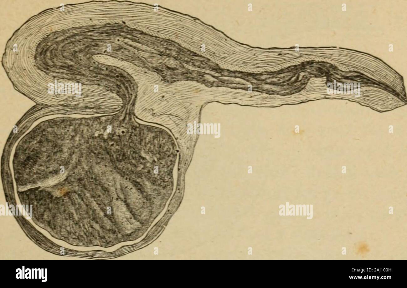 Patologia e terapia delle malattie delle donne ad uso dei medici pratici . rappresentala dalle fig. 189-190 e 191. Il contenuto della tuba viene verosimilmente un tingersi di sanguead ogni mestruazione, se piare non si versa sangue puro. Alcuni fra imiei preparati lasciano sospettare che durante la mestruazione si avve-rino degli stravasi di sangue nelle tube, e che questo sangue, se nonviene riassorbito, si riversi allesterno attraverso allutero. Ma il sanguesi pu ò arrestare dietro coagulo delle Nazioni Unite, e la tuba si converte in una sacca (1) Questa forma di fusione fu da me illustrata nella mia turch Foto Stock