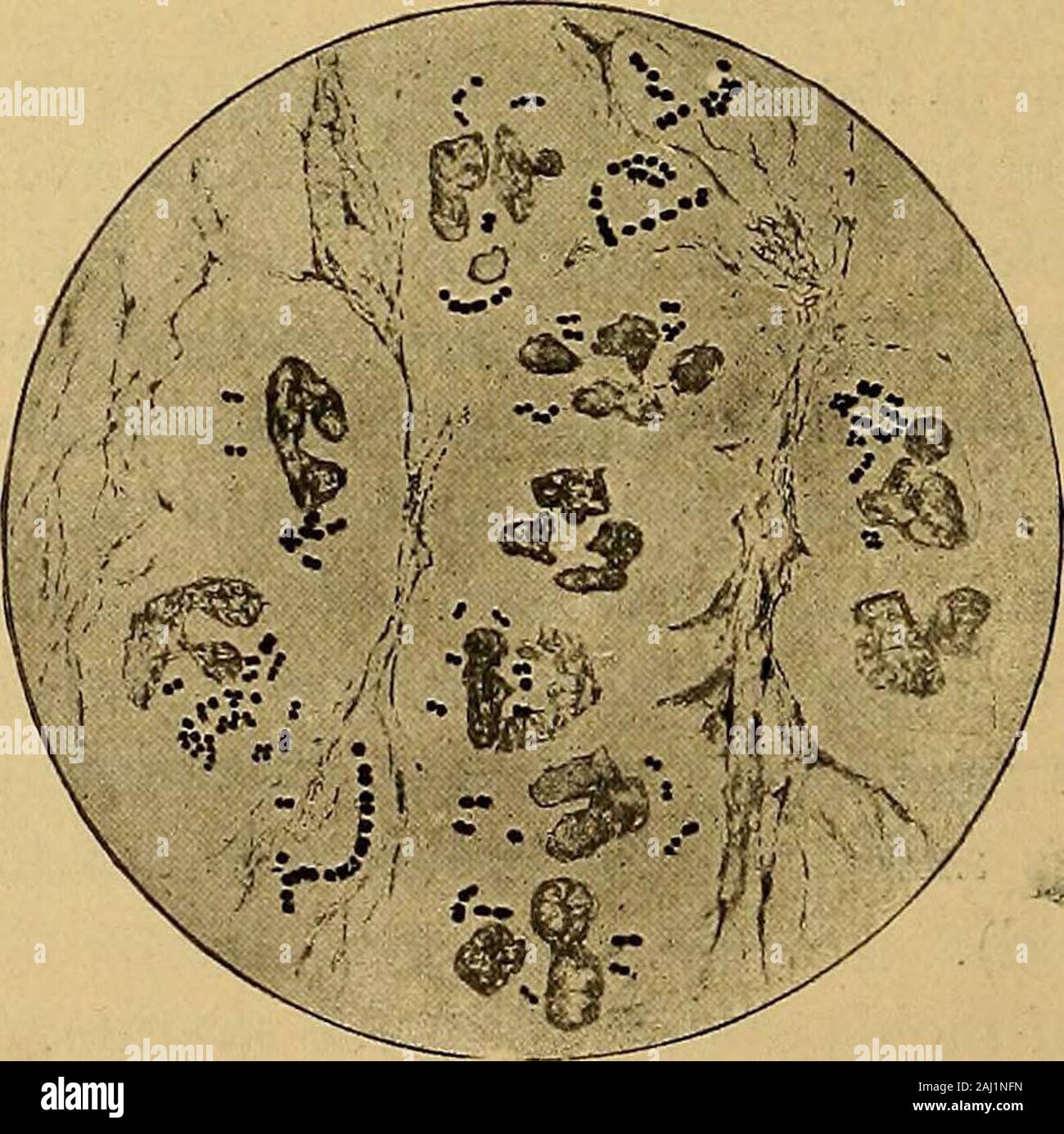 I metodi diagnostici, chimici e batteriologici microscopiche : un libro di testo per studenti e professionisti del settore . Fig. 3.-Aspergillus fumigatus. aspergillus sono il flavus, Niger, e la sub-fuscus. Il penicillium glaucumand l'oidio albicans sono occasionalmente trovati nel sputa. Tra i batteri che possono essere puramente saprofiti si possono trovare almostany di pus di organismi di formazione. Più frequentemente però quando questi o-ganisms sono presenti in un numero eccessivo di una contaminazione o un patogeno diretto. Fig. 4.-Micrococcus catarrhalis. (Dal chimico Emerys batteriologia, influenza dovrebbero essere suspec Foto Stock
