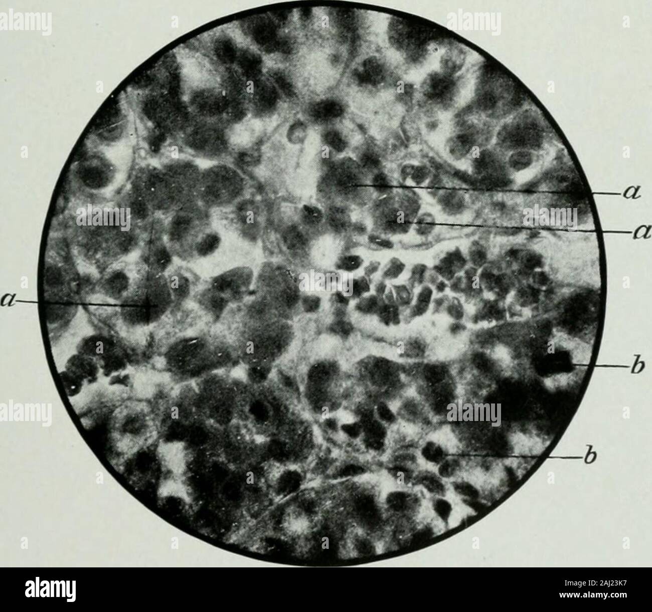 Le secrezioni interne e i principi della medicina . Fig. 2.. L'epitelio DF IL ANTERIDR PITUI-TARY ilS parzialmente CDMPDSEU DP FHACDCYTICEPITHELIDIU CELLULE, [S^jaus.] Fig, 1, EpitHBllold cBlls in un tubercolare ghiandola linfatica un.llolfcfeUs f! ^ ° *^^ la ghiandola pituitaria. Phagccytic: epltha- 4 leucociti come distributori di veleni e rimedi. 1041 anche se qui e là disposte in ordine a causa della con-tiguity delle loro pareti tubolari o dello stroma, sono ammassato .promiscu-ously. Questo è chiaro nuide dal taglio di seguito riprodotta da apaper da Launois e Mulon,^^ che mostra secondo theirdescription, Foto Stock