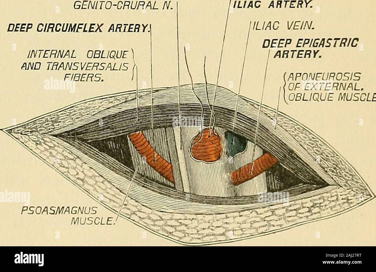 Intervento chirurgico . perior processof spinoso l'ileo (Fig. 181, /). La fascia superficiale, aponeurosis della ex-interna obliqua, le fibre muscolari dei obliqua interna e la trans-versalis, vengono separatamente di-fornito su una gola di-rettore. Lo scudo trans-versalis è accuratamente pickedup con il pollice per-ceps e una piccola openingmade attraverso di esso, intowhich il direttore è in-el e lo scudo di-fornito. Il suo peritonaeumand subserous tissueare poi attentamente raisedfrom la fascia iliaca, andpressed verso l'alto e in-ward fino a quando la parte esterna bor-der degli psoas magnus è accertato, quando Foto Stock