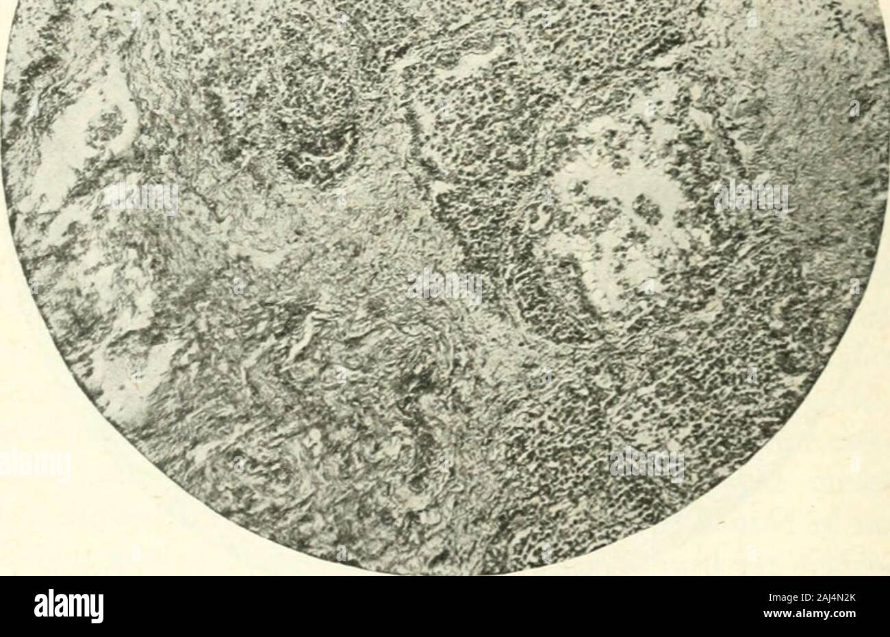 Le cliniche mediche del Nord America . Fig. 108.-tiroide. Iperplastica gozzo tossico con interstiziale cronica strumitis. il tessuto linfatico. Sparse attraverso di essa sono state numerose Hasselcorpuscles, che variano molto nelle dimensioni, alcune molto grandi andshowing stadi avanzati di hyalinization, mentre un occasionalsmall quello che appare abbastanza cellulare. Diffusa attraverso strutture thelymphatic erano grandi cellule mononucleate, spesso phago-cytic, verificano singolarmente come una regola, e possibilmente di origine endoteliale. 456 WILLIAM J. KERR, GLANVILLE Y. RUSK Milza.-i corpi malpighian variato molto in termini di dimensioni. In quelli thelarger Foto Stock