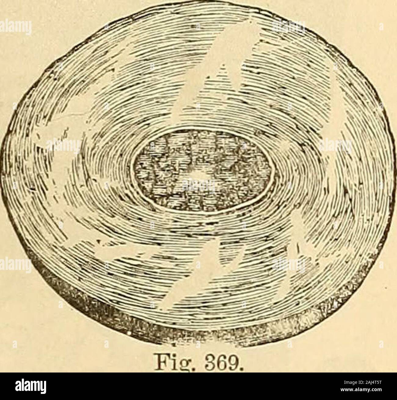 Clinica i principi e la pratica della medicina . loro non sono mai state organizzate o formedout di una struttura organica. Essi possiedono una notevole disposizione, come sempre, a raccogliere attorno a un nucleo centrale,che può essere organico o non organico, andoften presente come risultato di puro incidente.Quindi essi generalmente presentano una tendenza toassume la forma globulare o di forma ovale. AlbiiminousConcretions.-ha alreadybeen ha spiegato che albume forse precipi-tated da sue soluzioni in forma di mem brane-(p. 246.) Questo è talvolta così effectedas per produrre concrezioni di cui ho havelong po Foto Stock