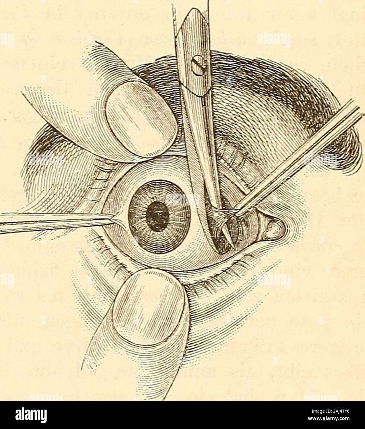 Lehrbuch der praktischen augenheilkunde . chen, indem man seine stumpfe Spitze fest an die Sclerotica andrücktund un derselben auf- und abwärts streift. Hat man die Fäden gefasst,così wird er in der vorerwähnten Weise durchschnitten, worauf der Bulbussogleich nach der anderen Seite weicht. Zeigt sich jetzt die Ablenkung auf ein Kleines reducirt, così mussdie Scheidenwunde nach oben und unten verlängert werden. Erübrigt abernoch eine beträchtlichere strabotische Ablenkung, così ist die Sehne des part ners am anderen Auge nach denselben Regeln zu durchschneiden. Genügtauch das nicht völlig in modo ist die Foto Stock