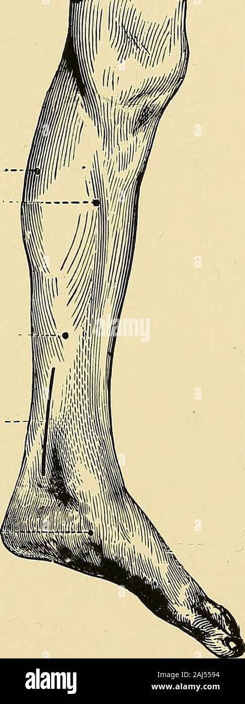 Un manuale pratico di elettricità medica : i raggi röntgen e Finsen luce . Peroneo nervo. Ext. testa del gastroc-nemius.soleus. Estensore longus digi-torum communis. Peroneus brevis.soleus. Longushallucis flessori. Estensore communisdigitorum brevis. Abductor minimidigiti. Fig. io8.-motore di punti della superficie esterna della gamba (Ziemssen). presente nessun semplice strumento con cui misurare lacorrente - forza di indotte correnti alternate. Acomparison delle reazioni dei due lati sarà ofmost valore, in particolare se il galvanometro, utilizzato subse- {Electro-Diagnosis 211 temente con la costante Foto Stock